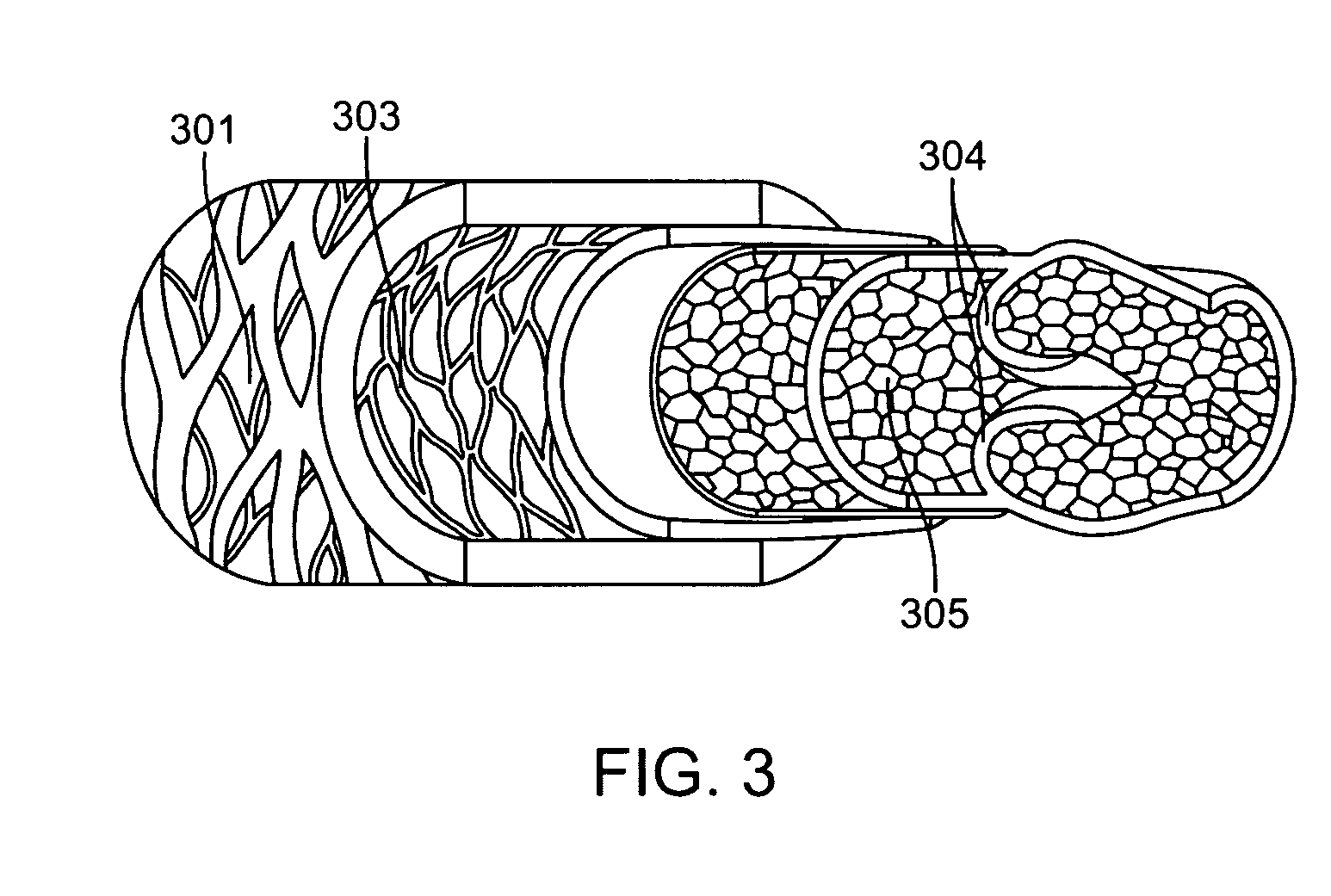 Apparatus for percutaneously creating native tissue venous valves