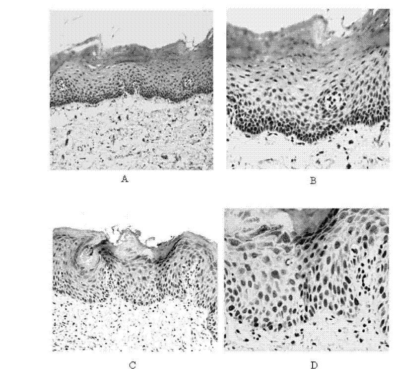 Oral cavity squamous carcinoma diagnosis reagent, reagent kit and preventing and controlling medicament