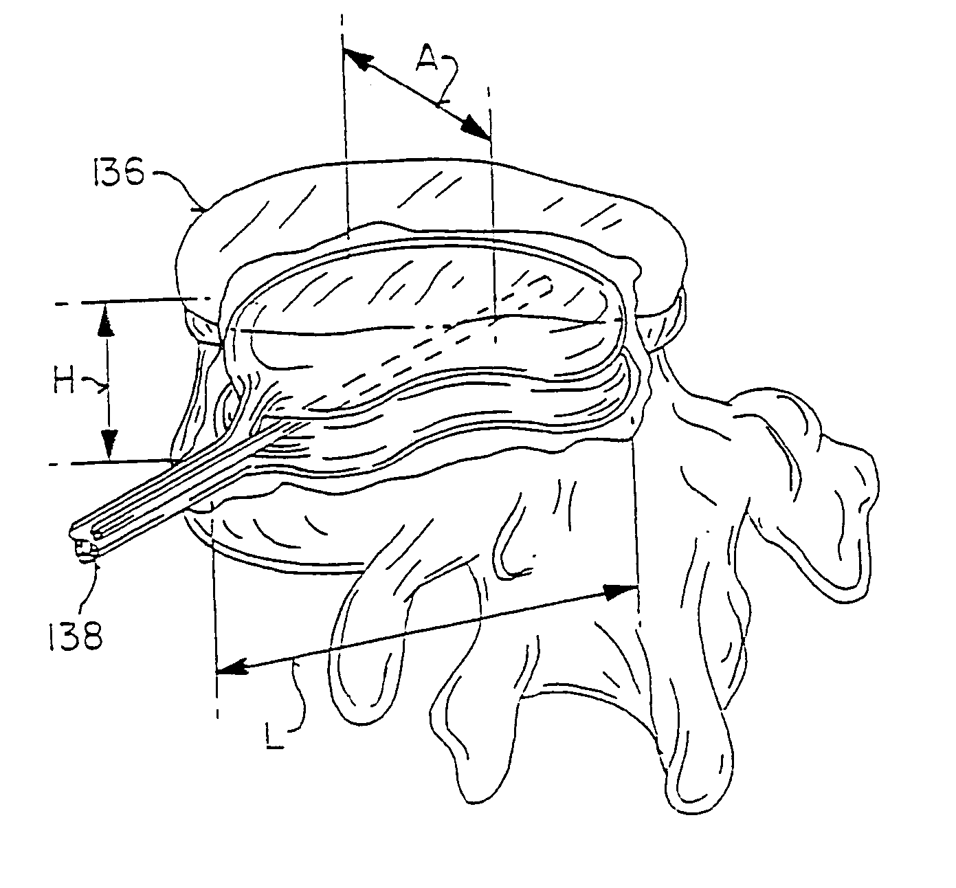 Vertebral body having an altered native cancellous bone volume and related treatment methods