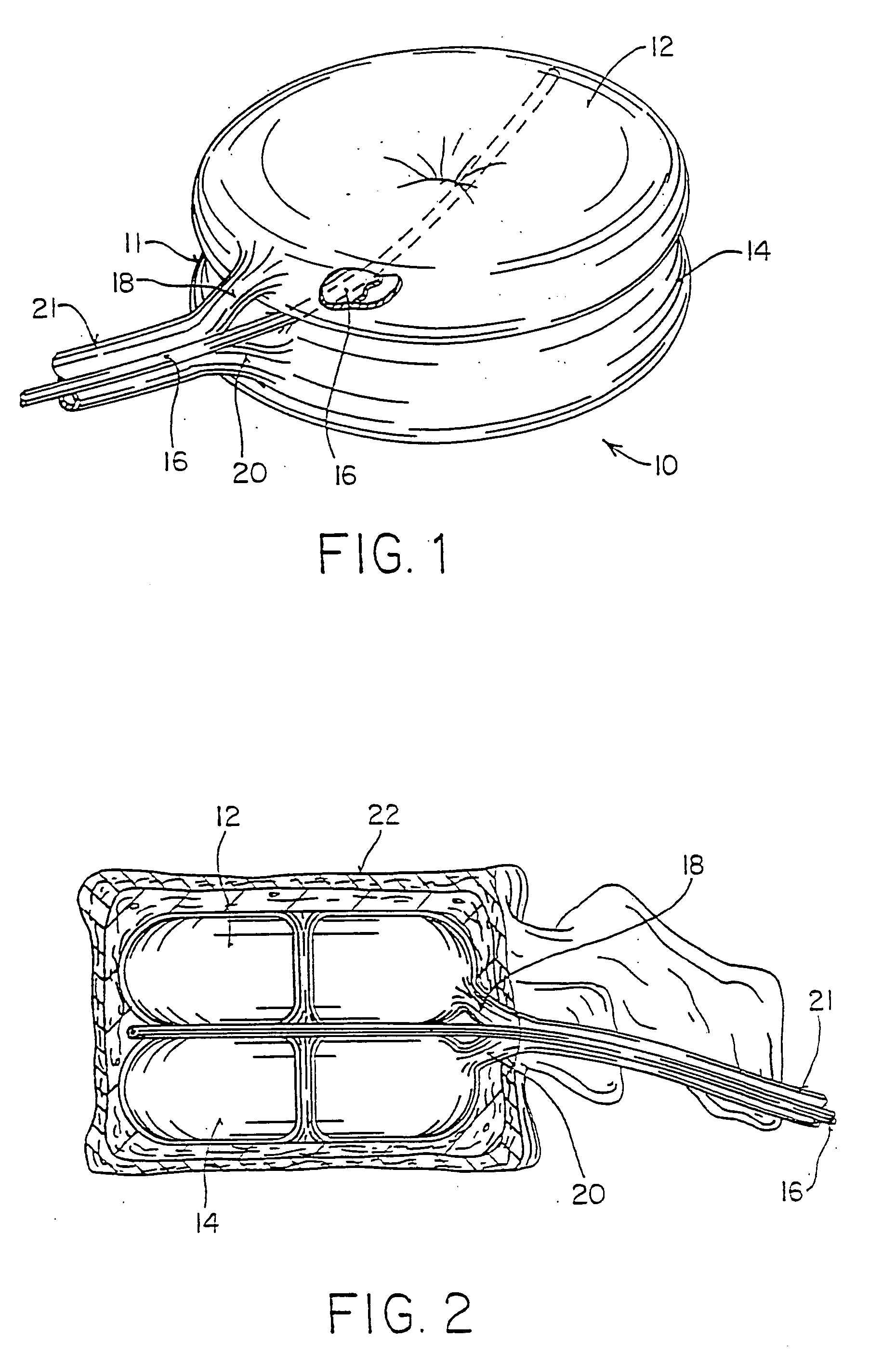 Vertebral body having an altered native cancellous bone volume and related treatment methods