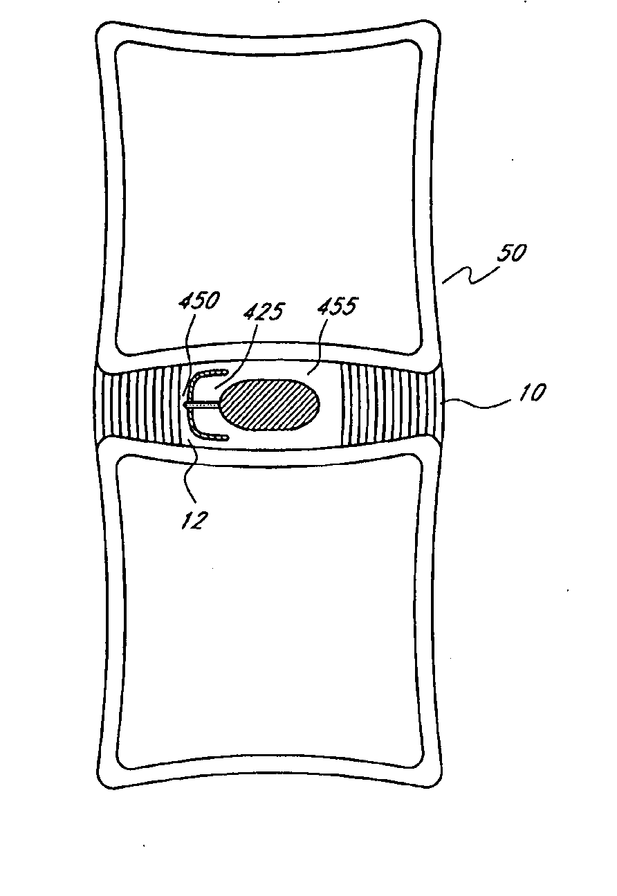 Method of anchoring an implant in an intervertebral disc