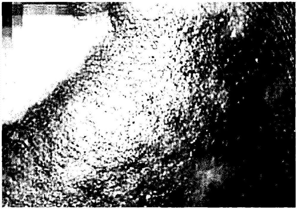 Apparatus for treating blood vessels in skin