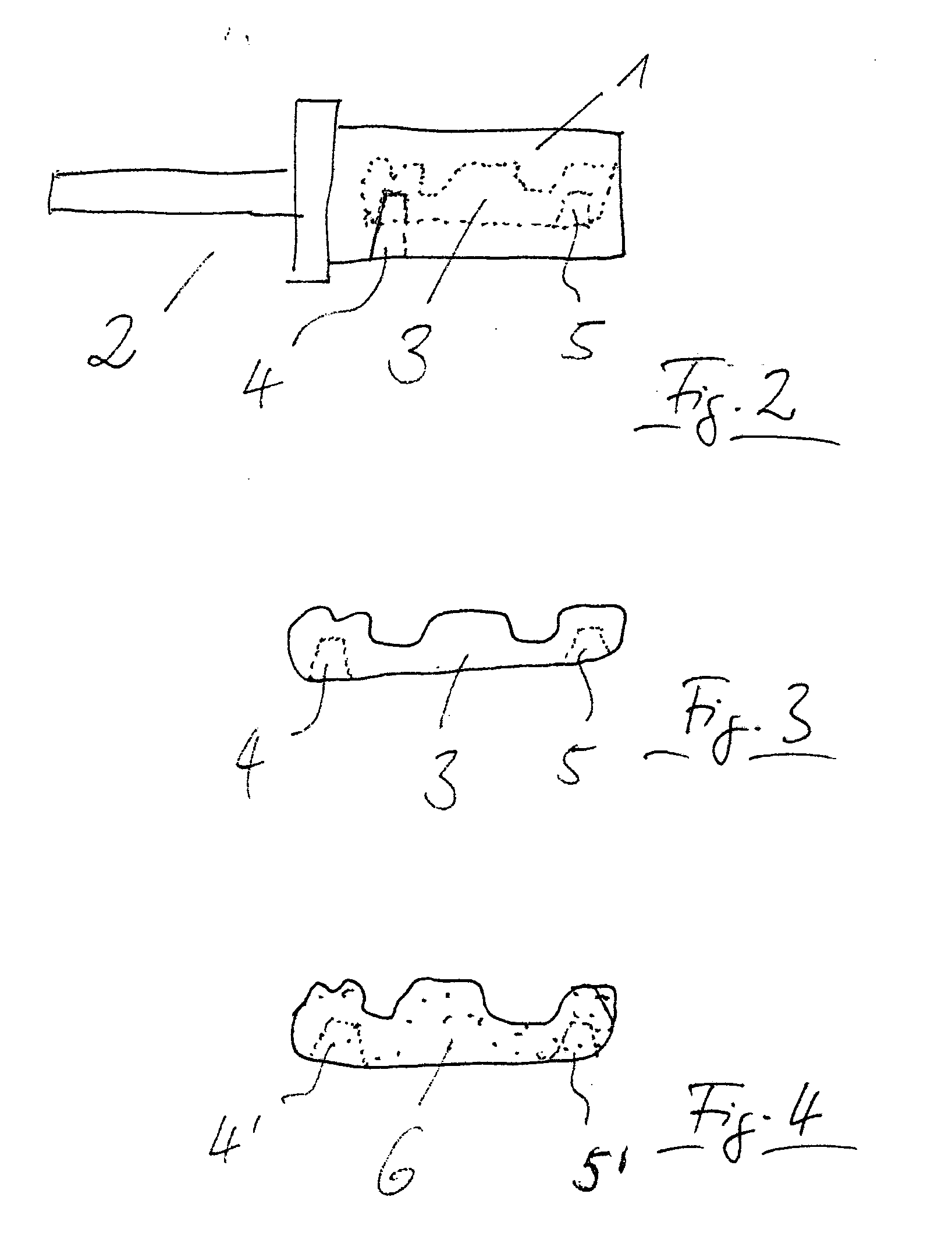 Method for producing a metallic dental implant and a blank for carrying out said method