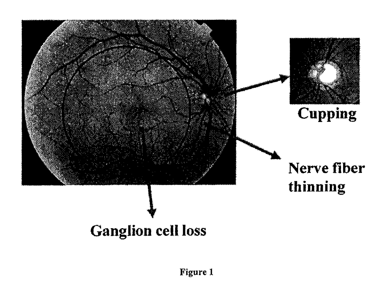 Methods for diagnosing glaucoma utilizing combinations of FD-OCT measurements from three anatomical regions of the eye