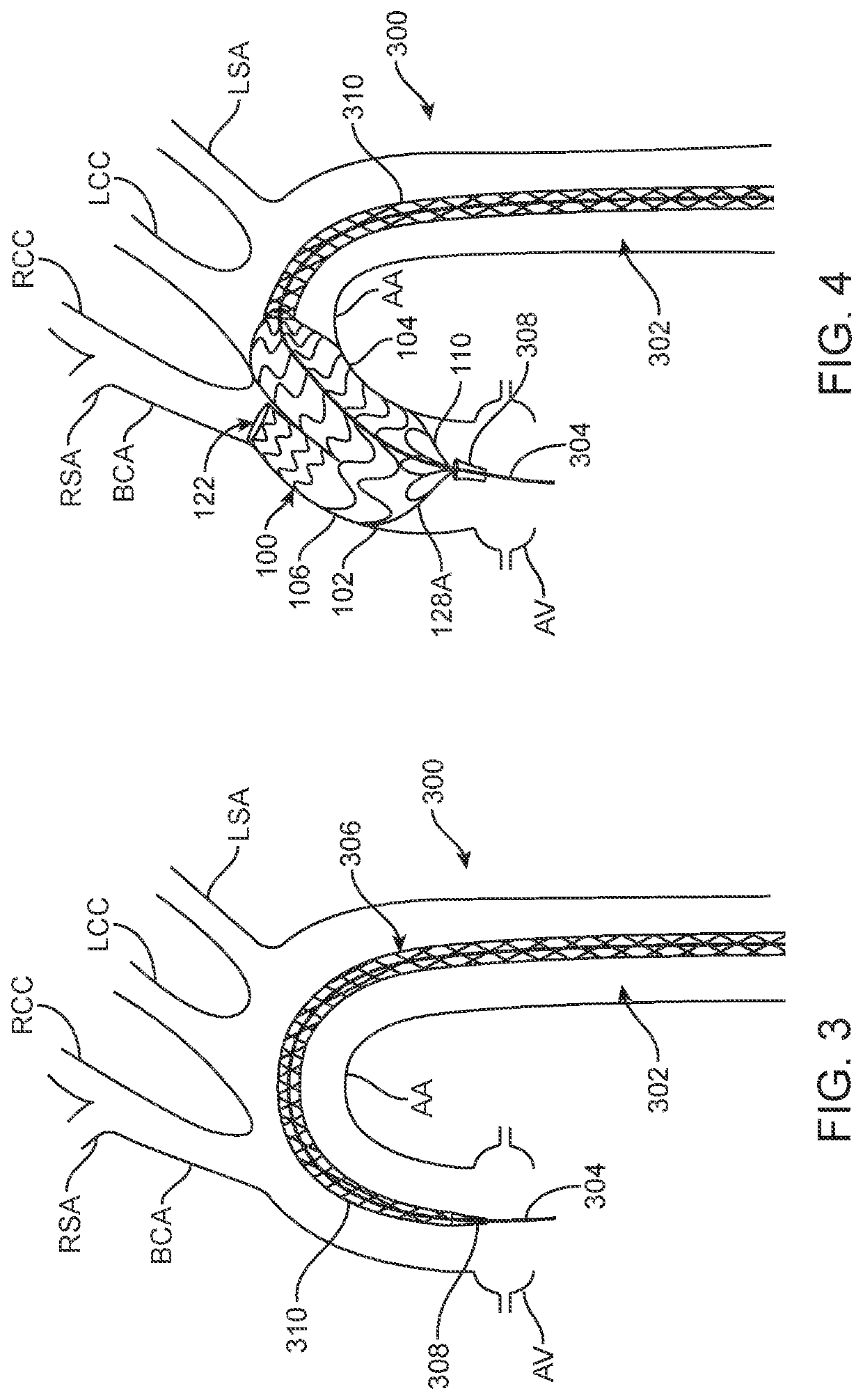 Femoral aortic access modular stent assembly and method