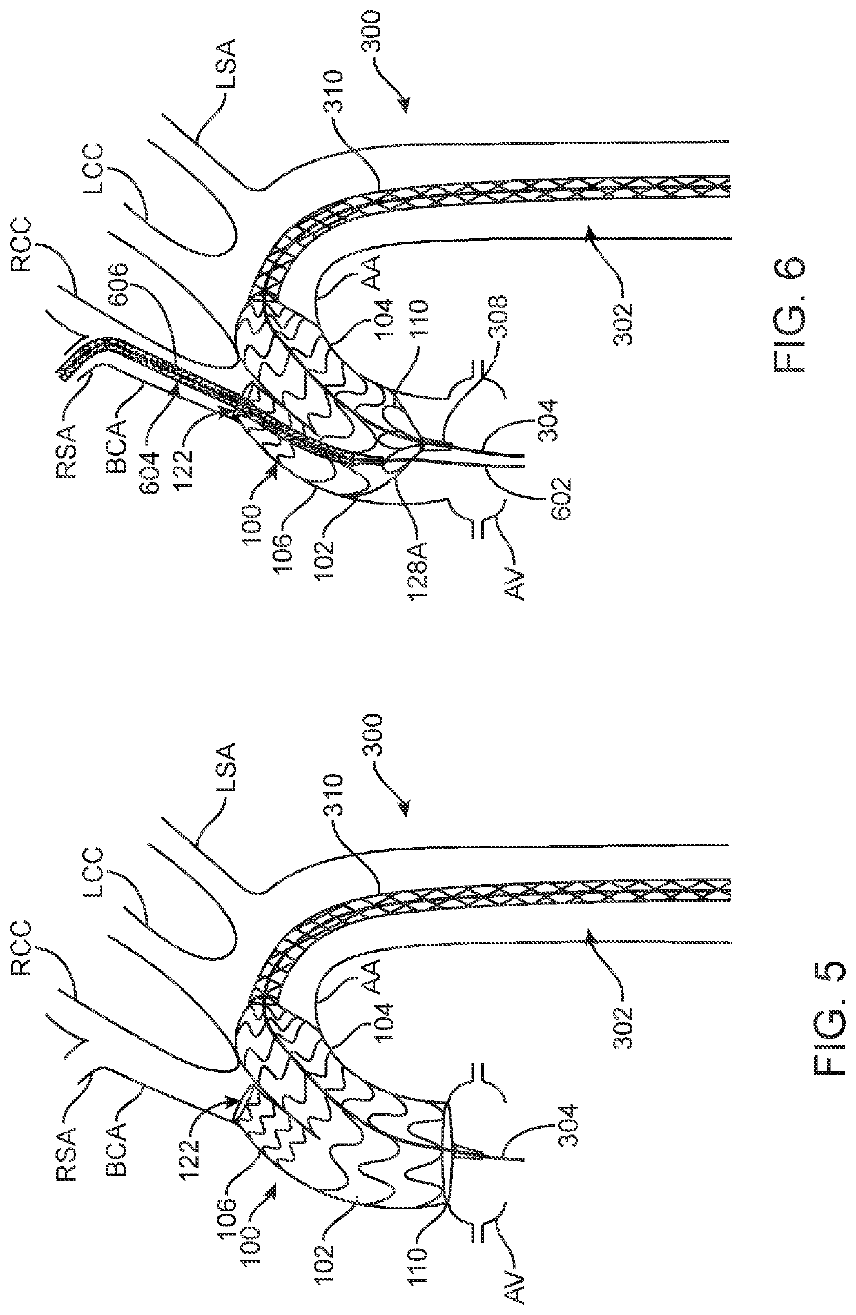 Femoral aortic access modular stent assembly and method