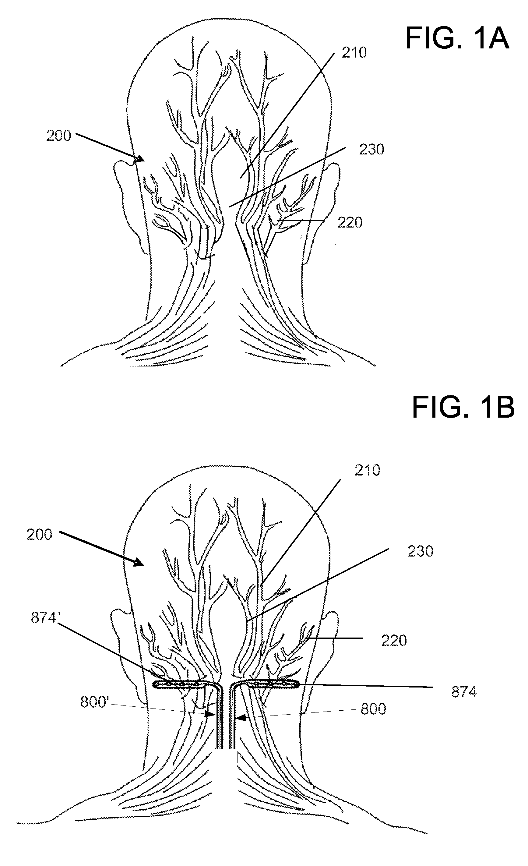 Anchor assembly for use in occipital nerve stimulation