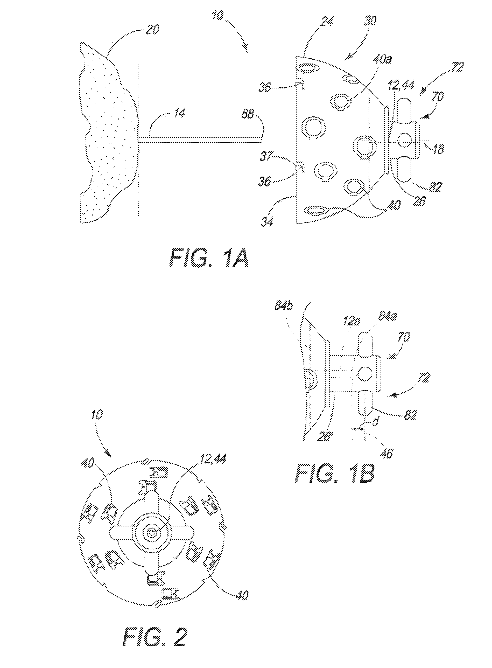 Guided reamer system for reshaping bone