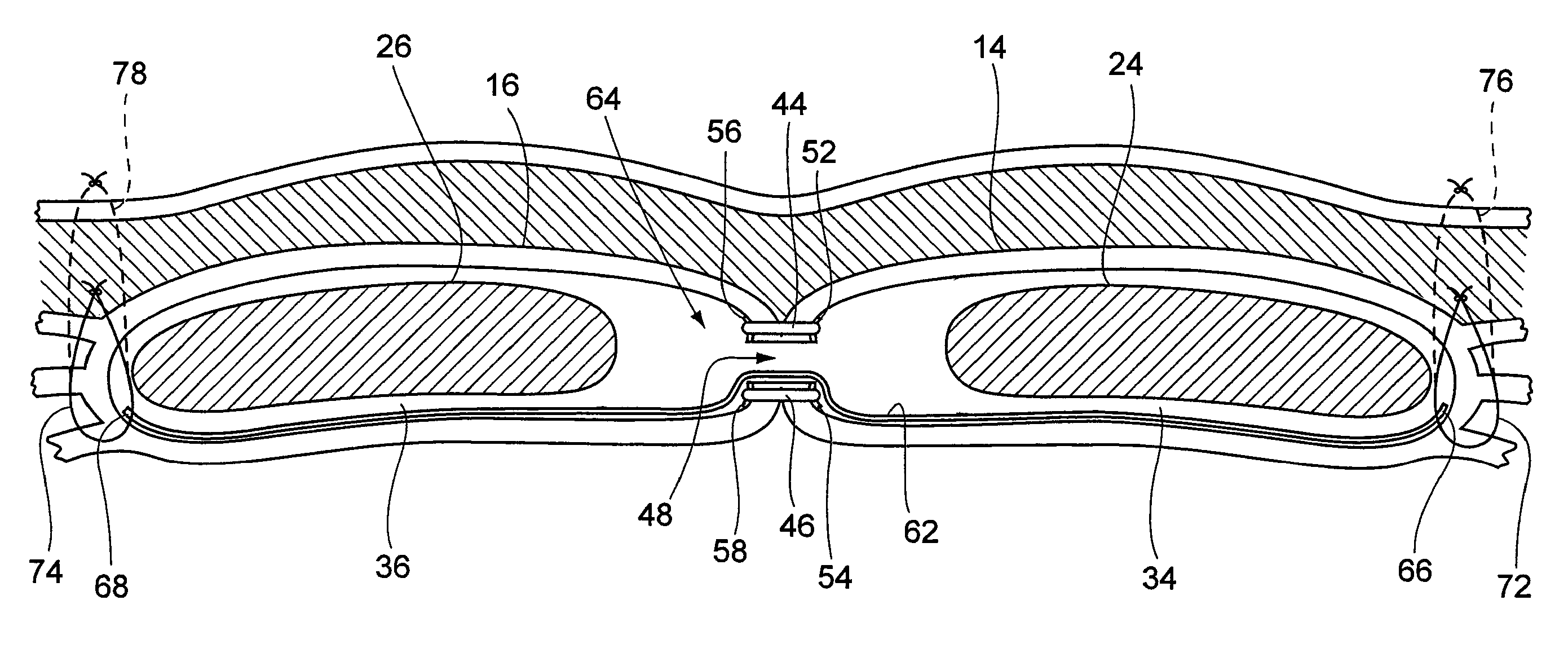 Ventral hernia repair method