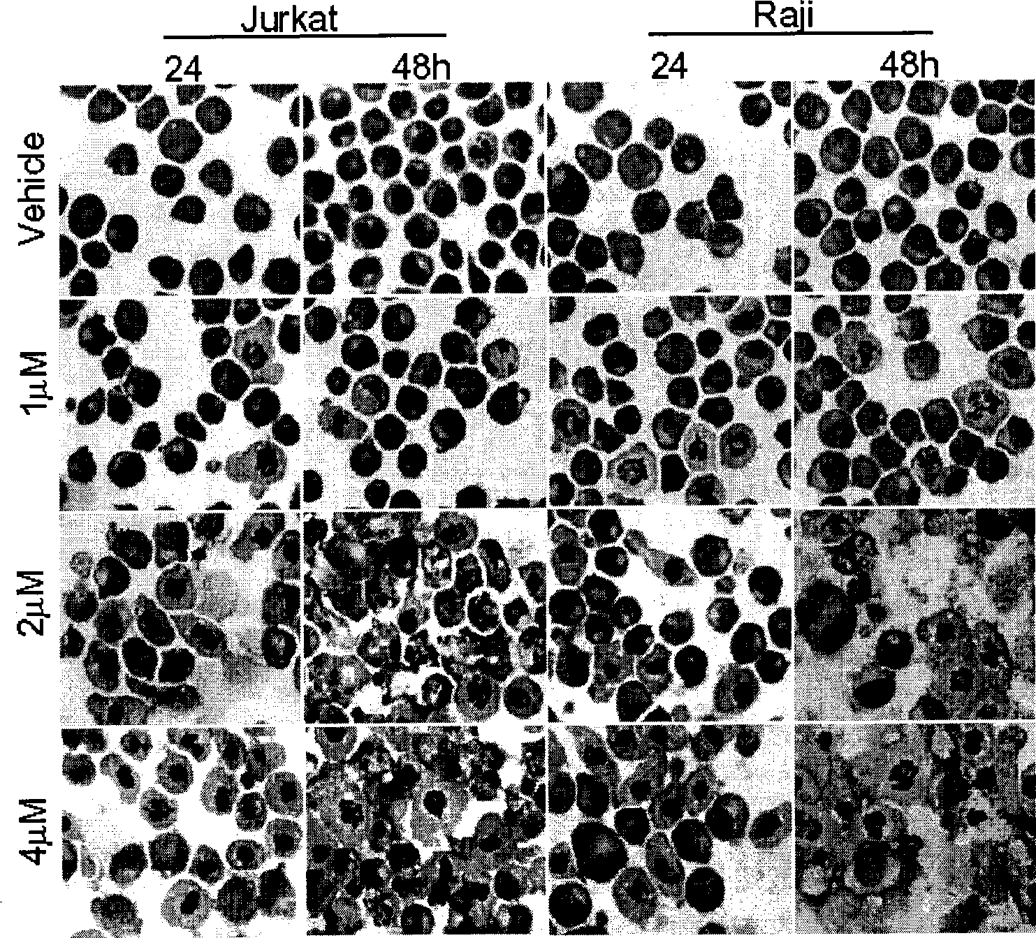 Use of Sichuang-Tibet amethystoidin A in preventing and treating acute lymphocyte leukaemia and cervical cancer