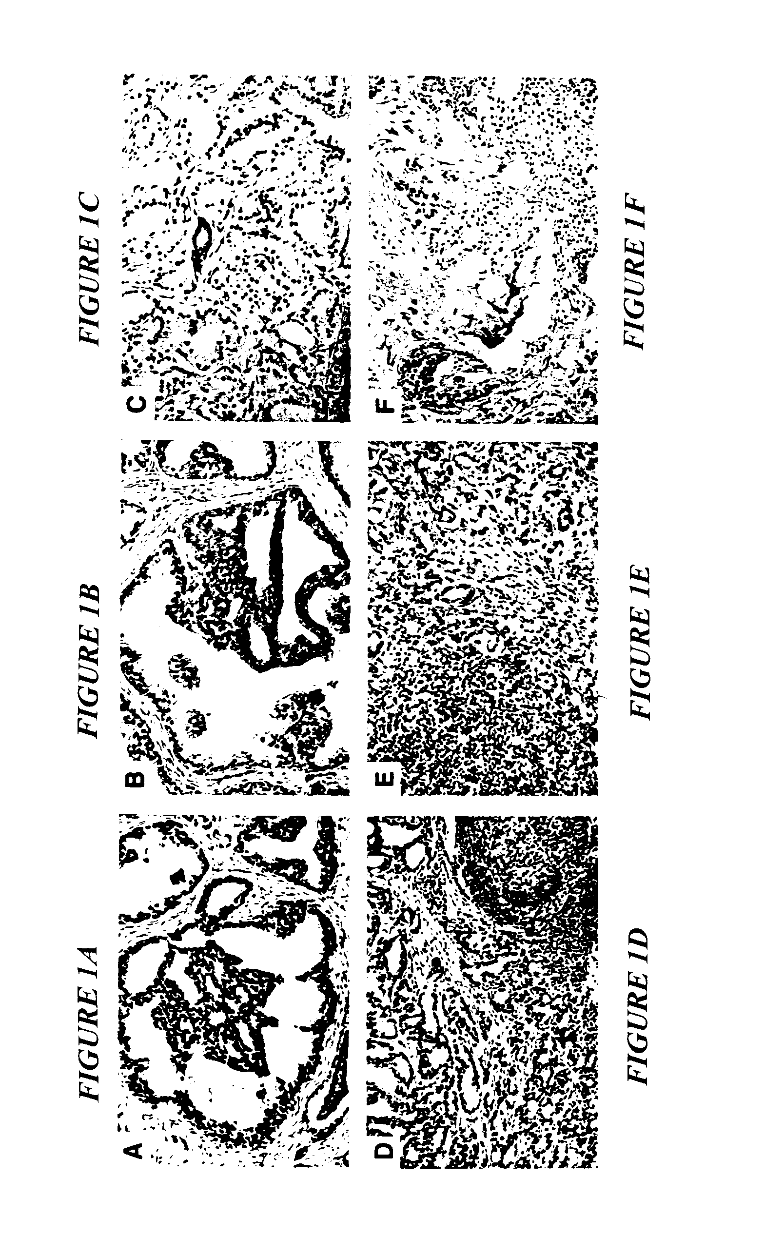 Markers for prostate cancer