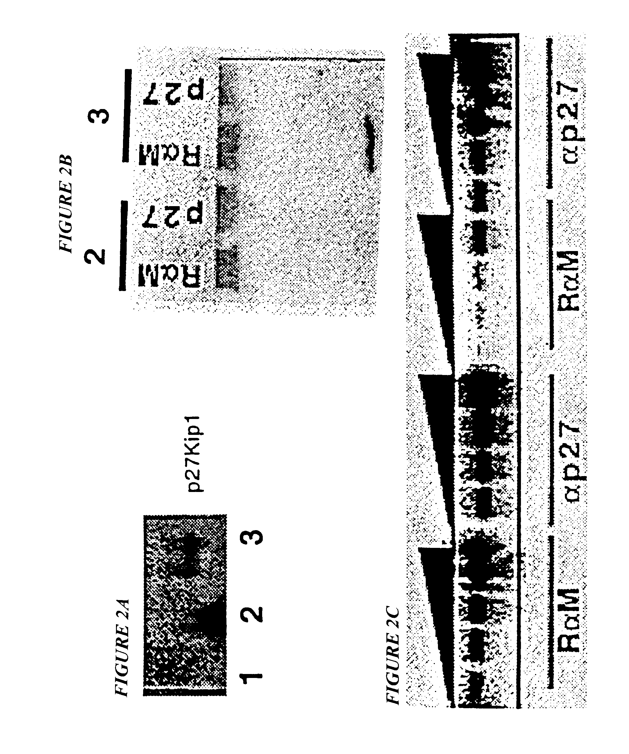 Markers for prostate cancer