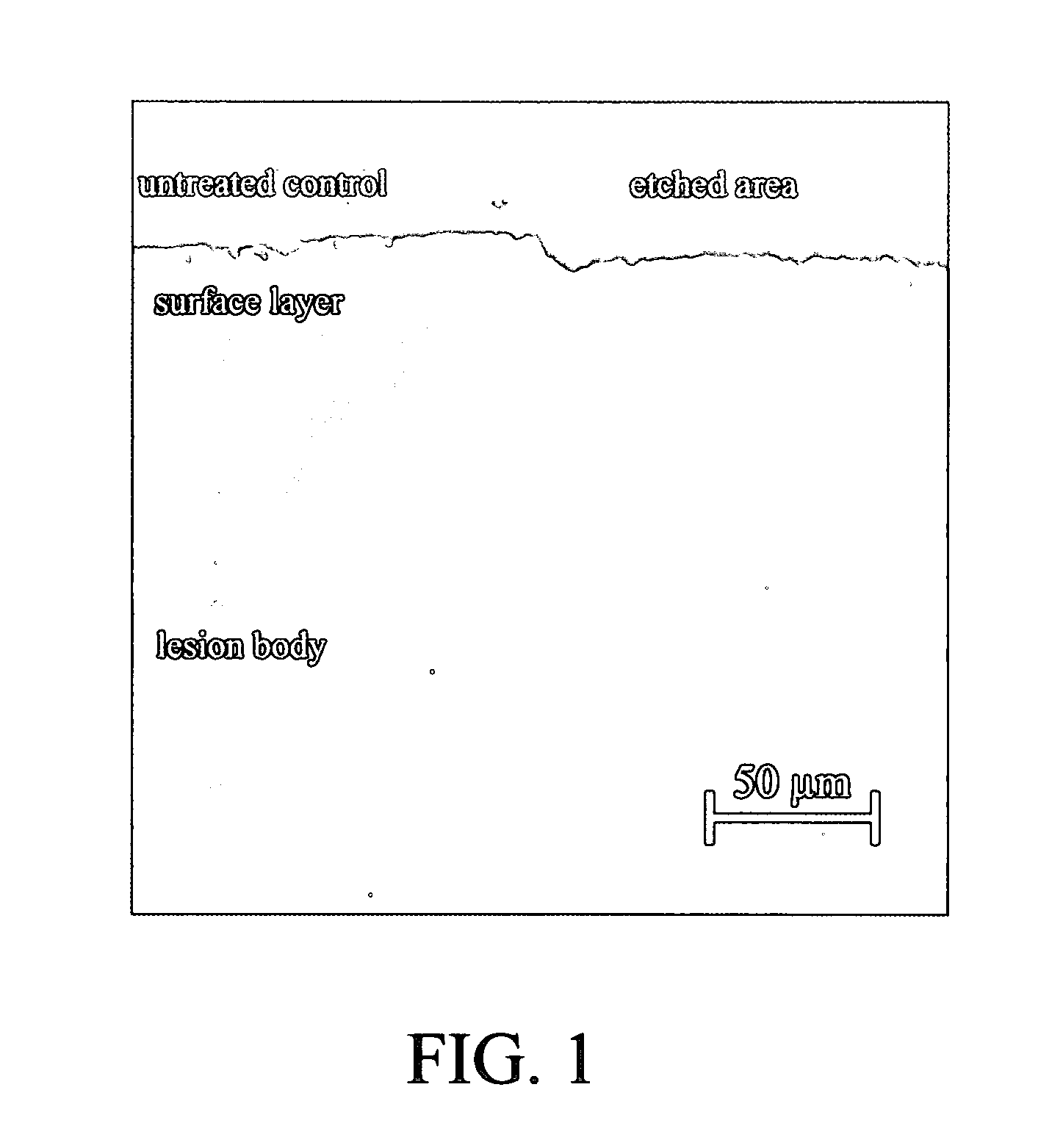 Method of infiltrating enamel lesions