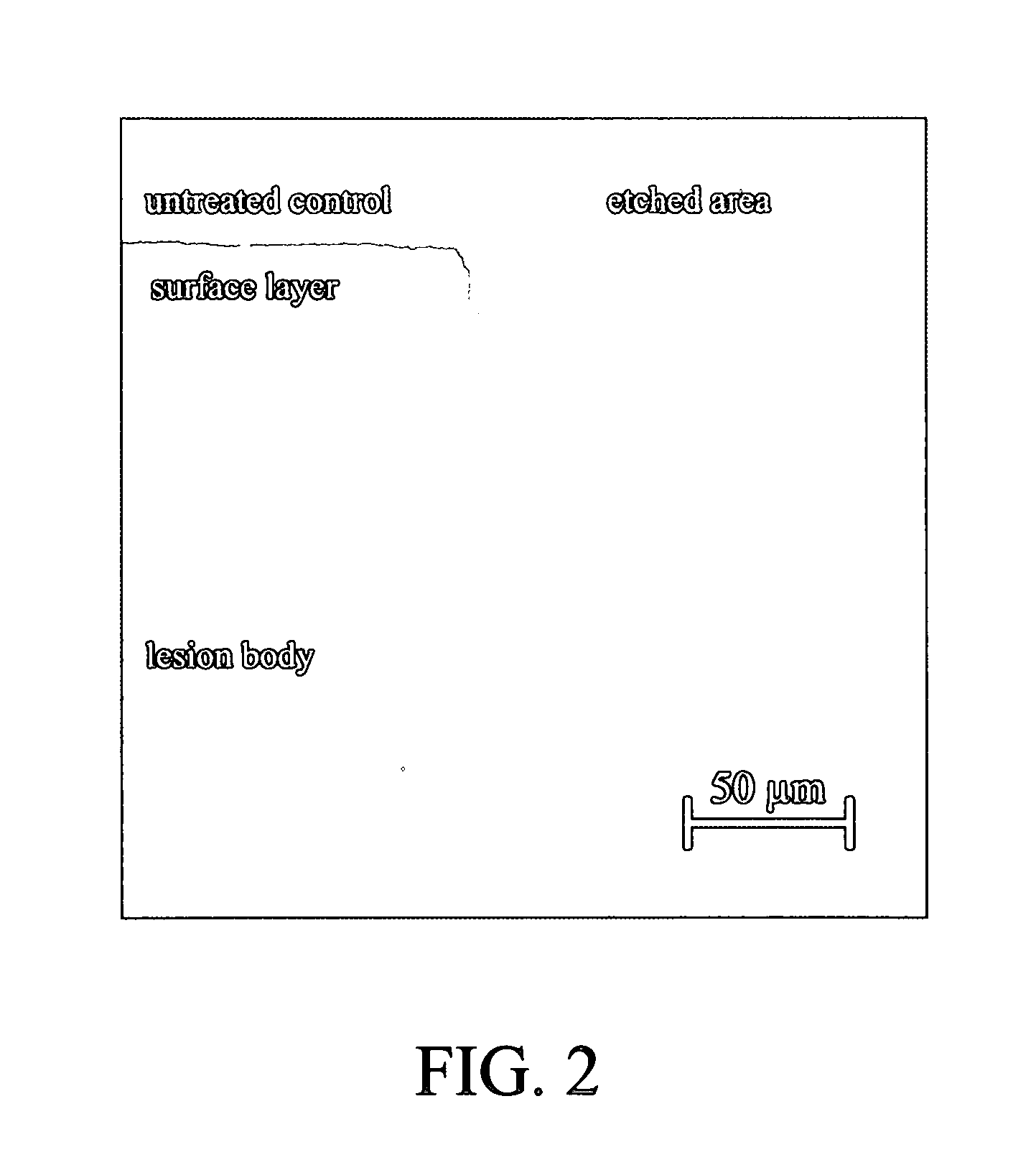 Method of infiltrating enamel lesions