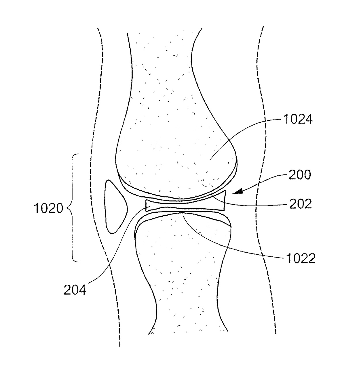 Interpositional Joint Implant