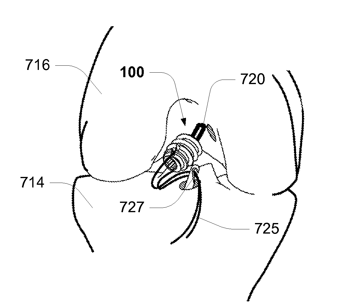 Swivel Screw Ligament Fixation Device