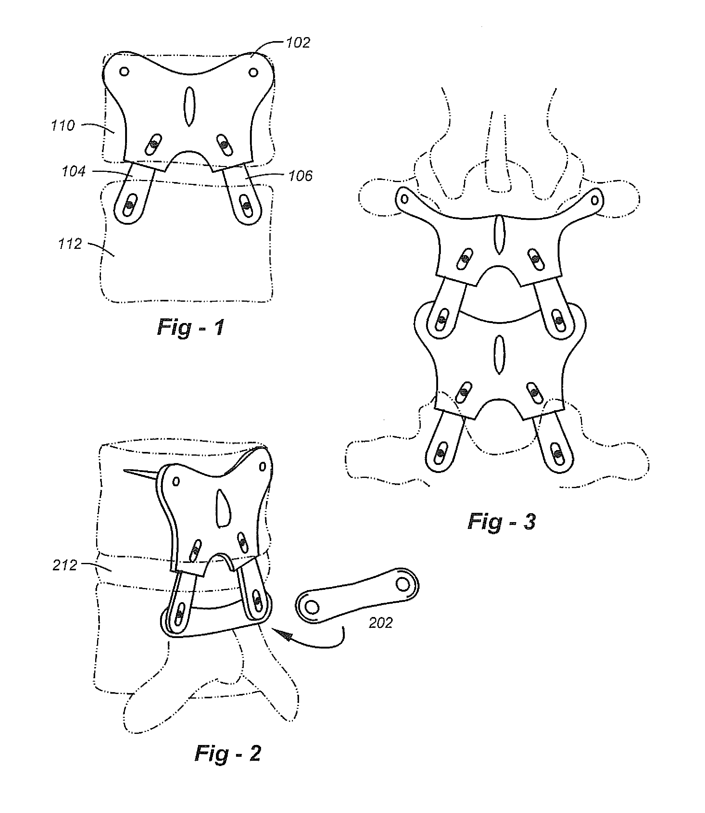 Posterior spinal reconstruction system