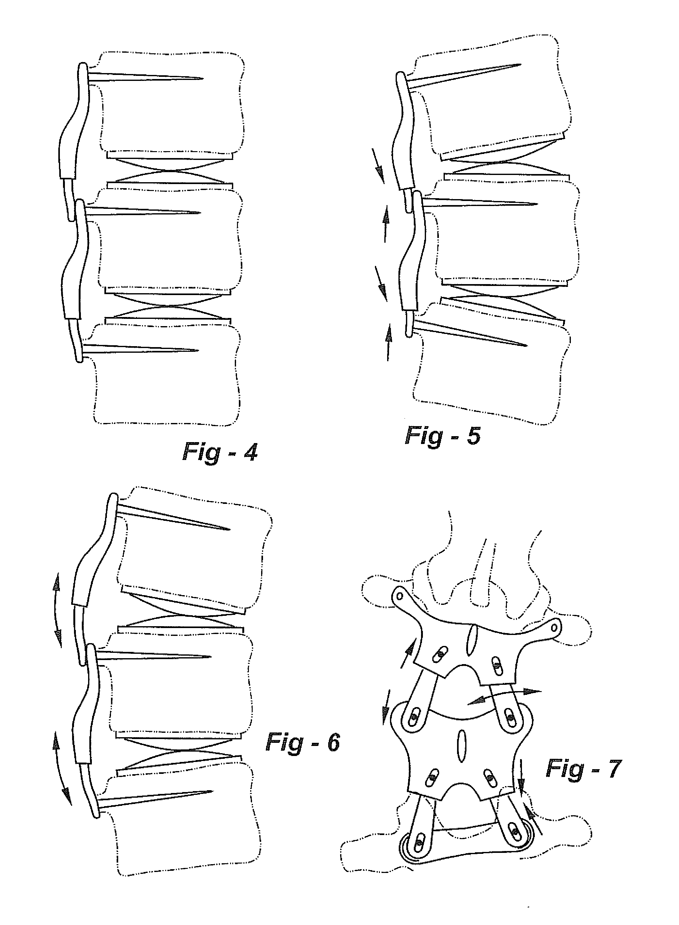 Posterior spinal reconstruction system