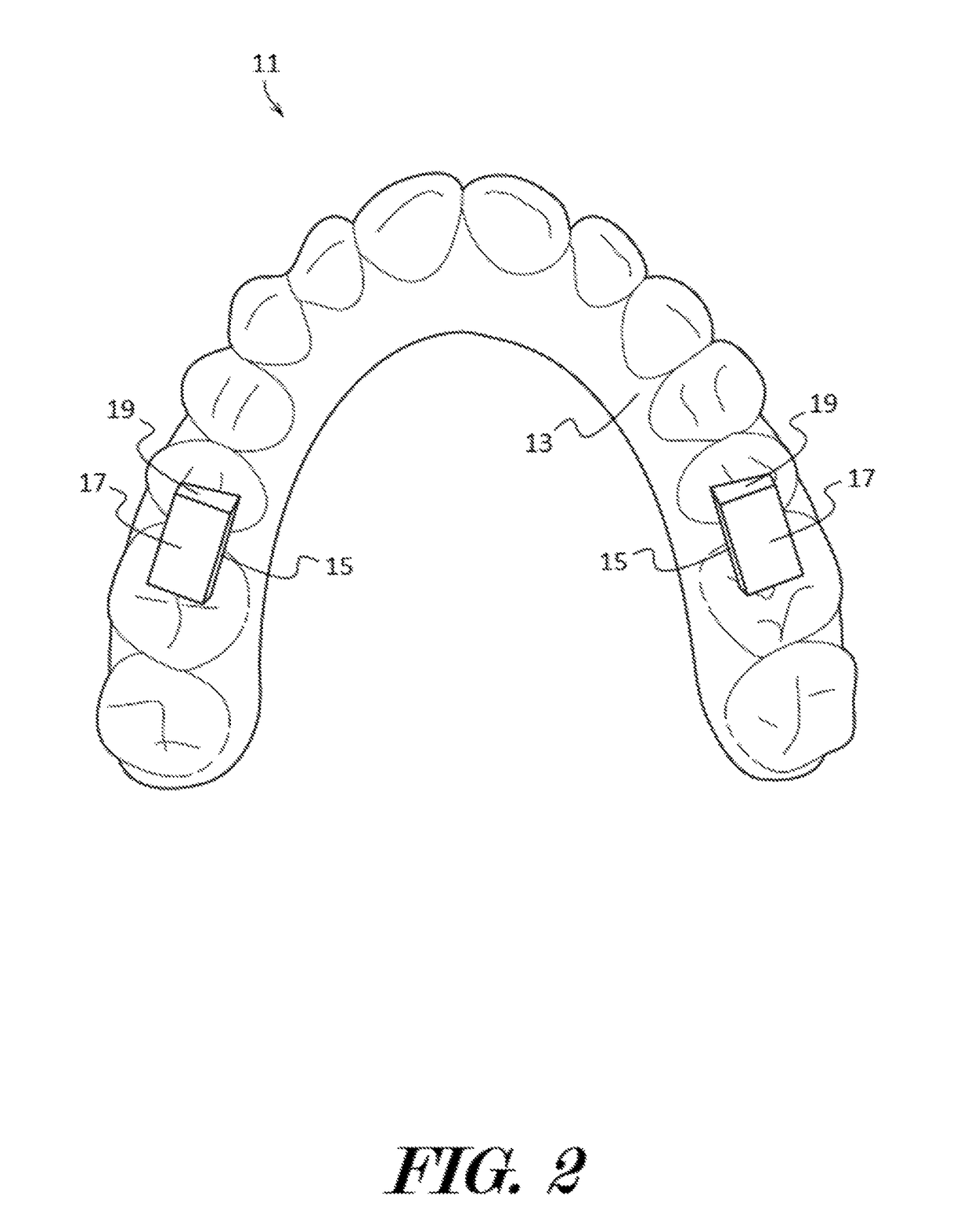 Oral apparatuses and methods for mandibular jaw manipulation