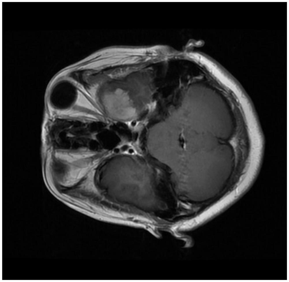 Brain image meningioma full-automatic screening and tumor segmentation method and device