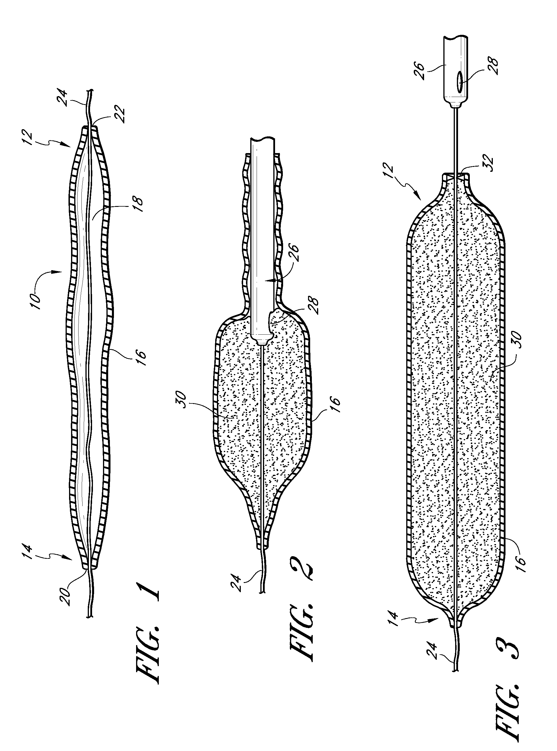 Tissue implant having a biased layer and compliance that simulates tissue