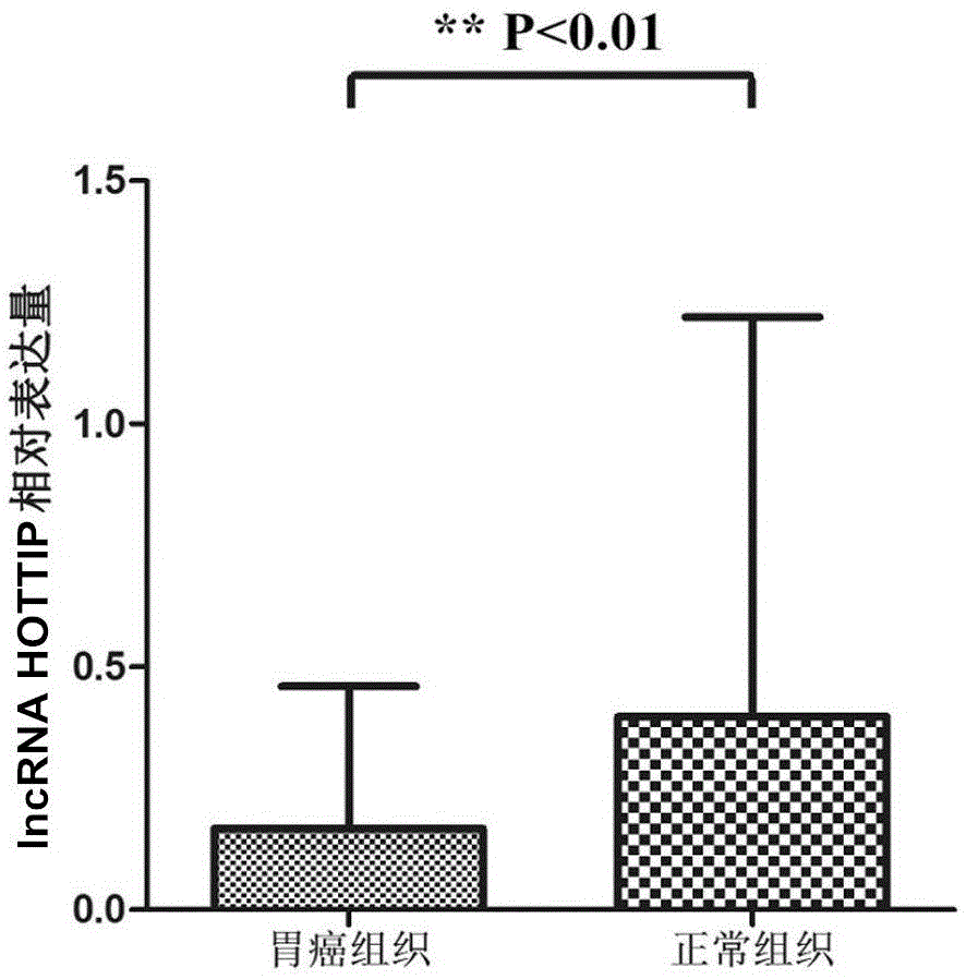 Detection and application of gastric carcinogenesis associated molecular marker IncRNA (long non-coding RNA) HOTTIP (HOXA transcript at the distal tip)