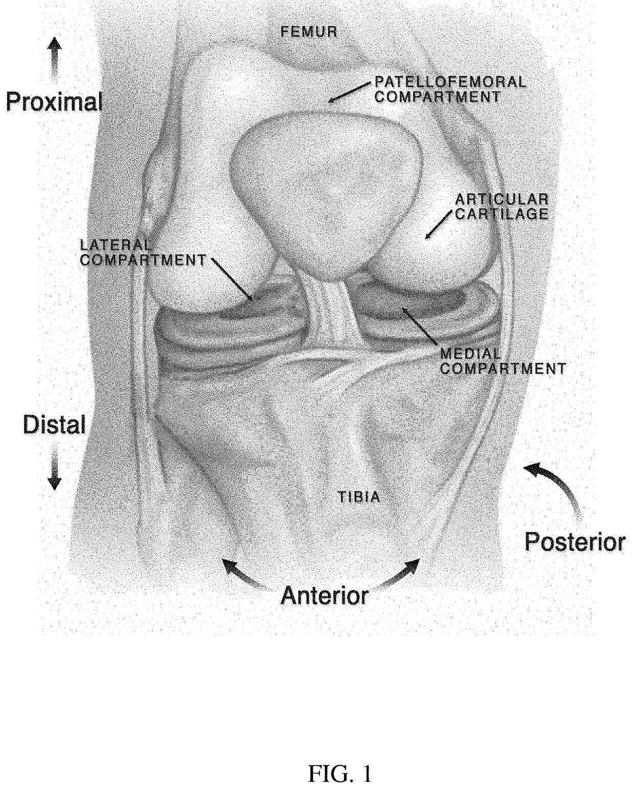 Unloading knee brace apparatus