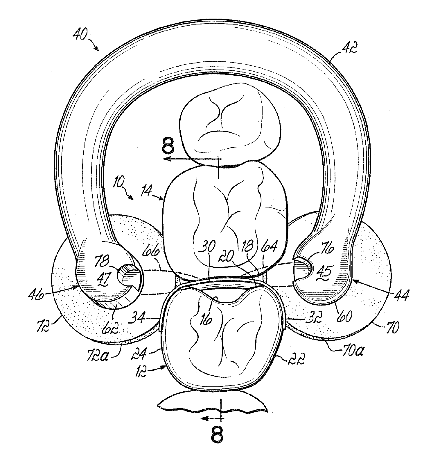 Device and system for separation and matrix retention and adaptation during dental restoration and method for preparing tooth using system