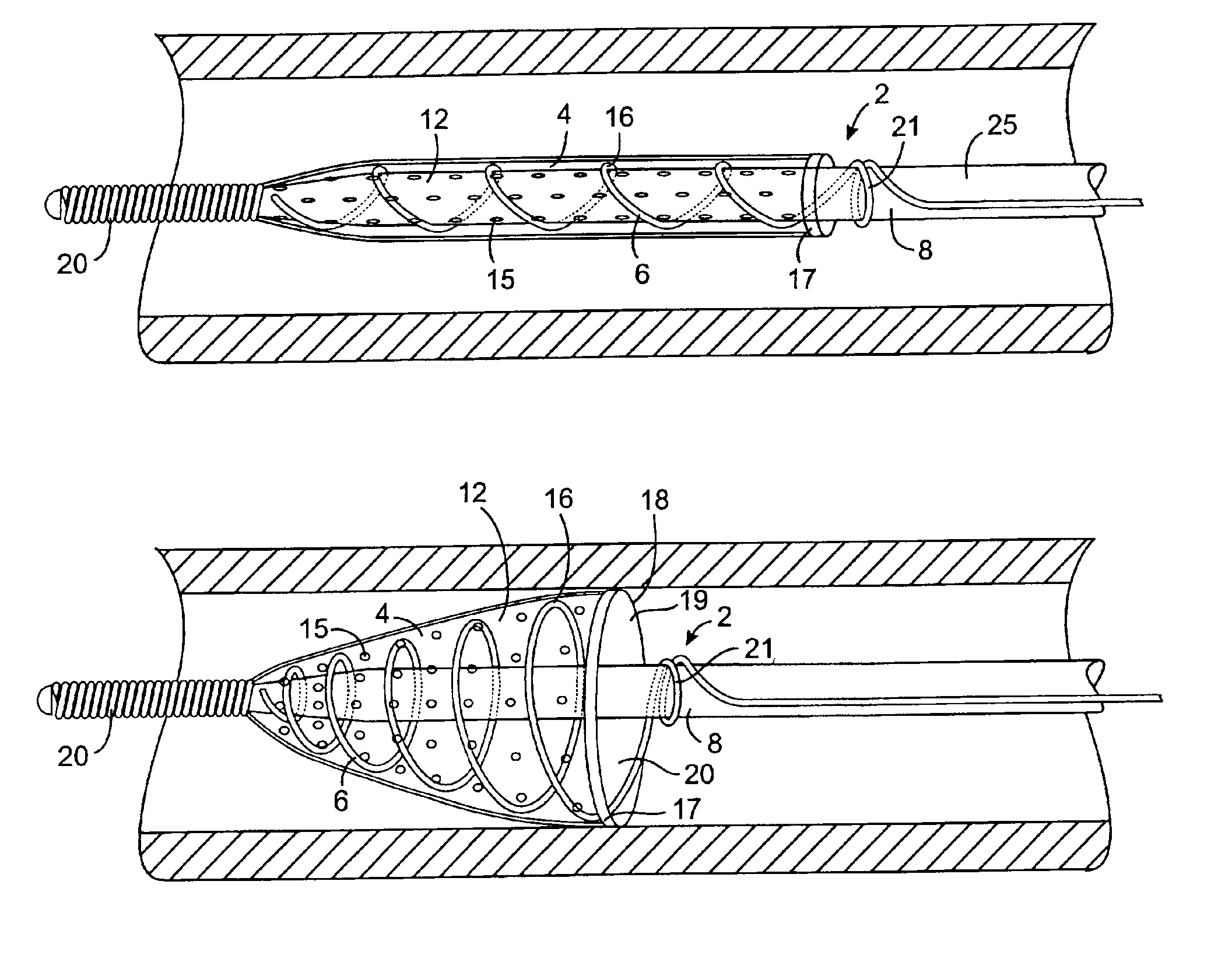 Methods and devices for filtering fluid flow through a body structure