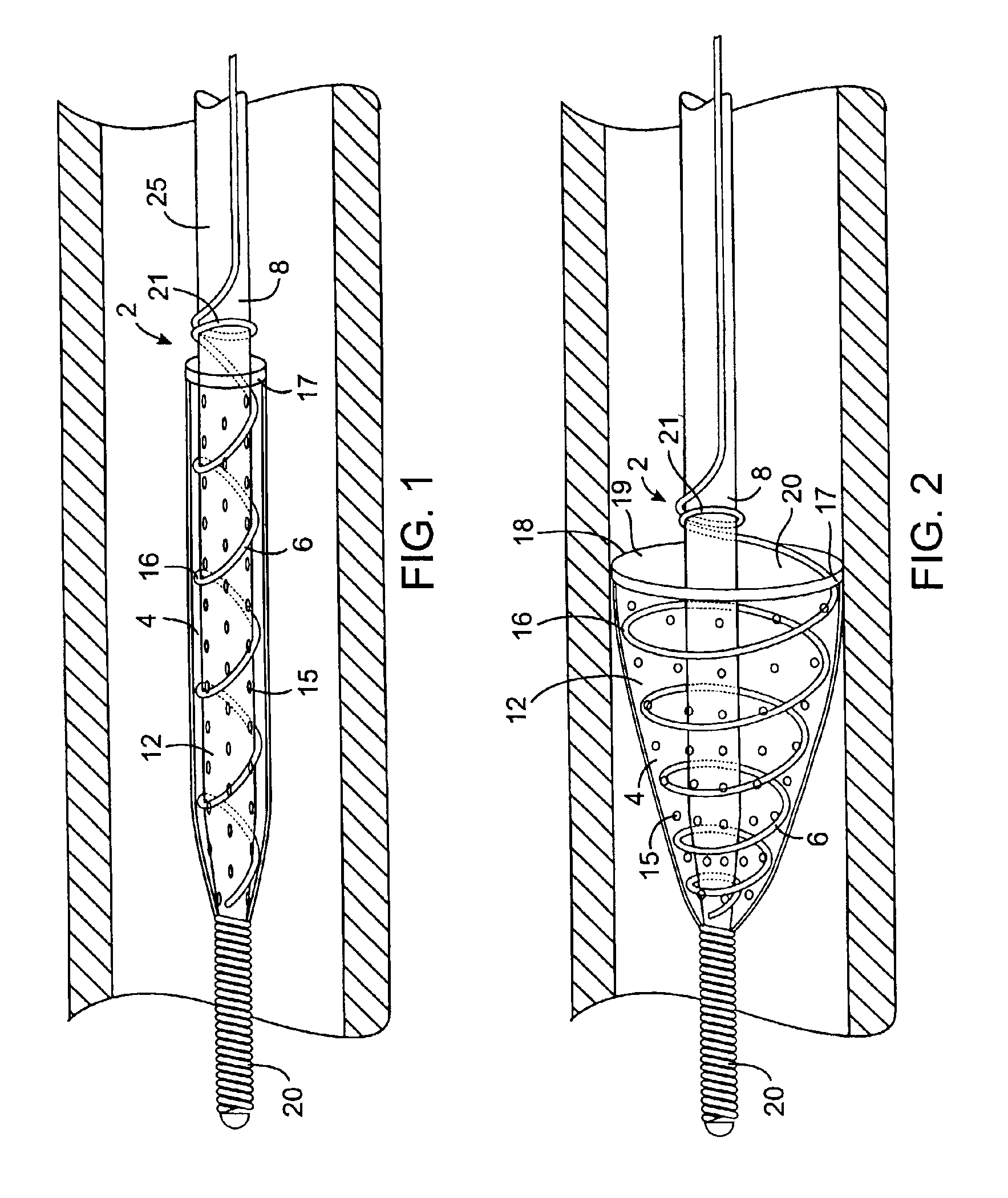 Methods and devices for filtering fluid flow through a body structure