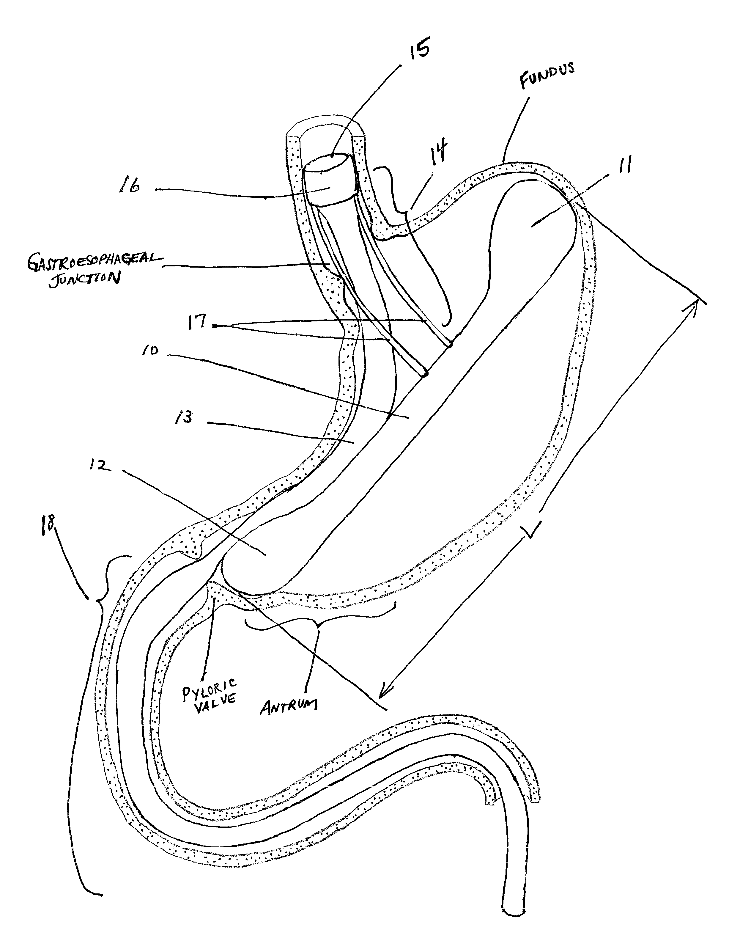 Intragastric implant devices