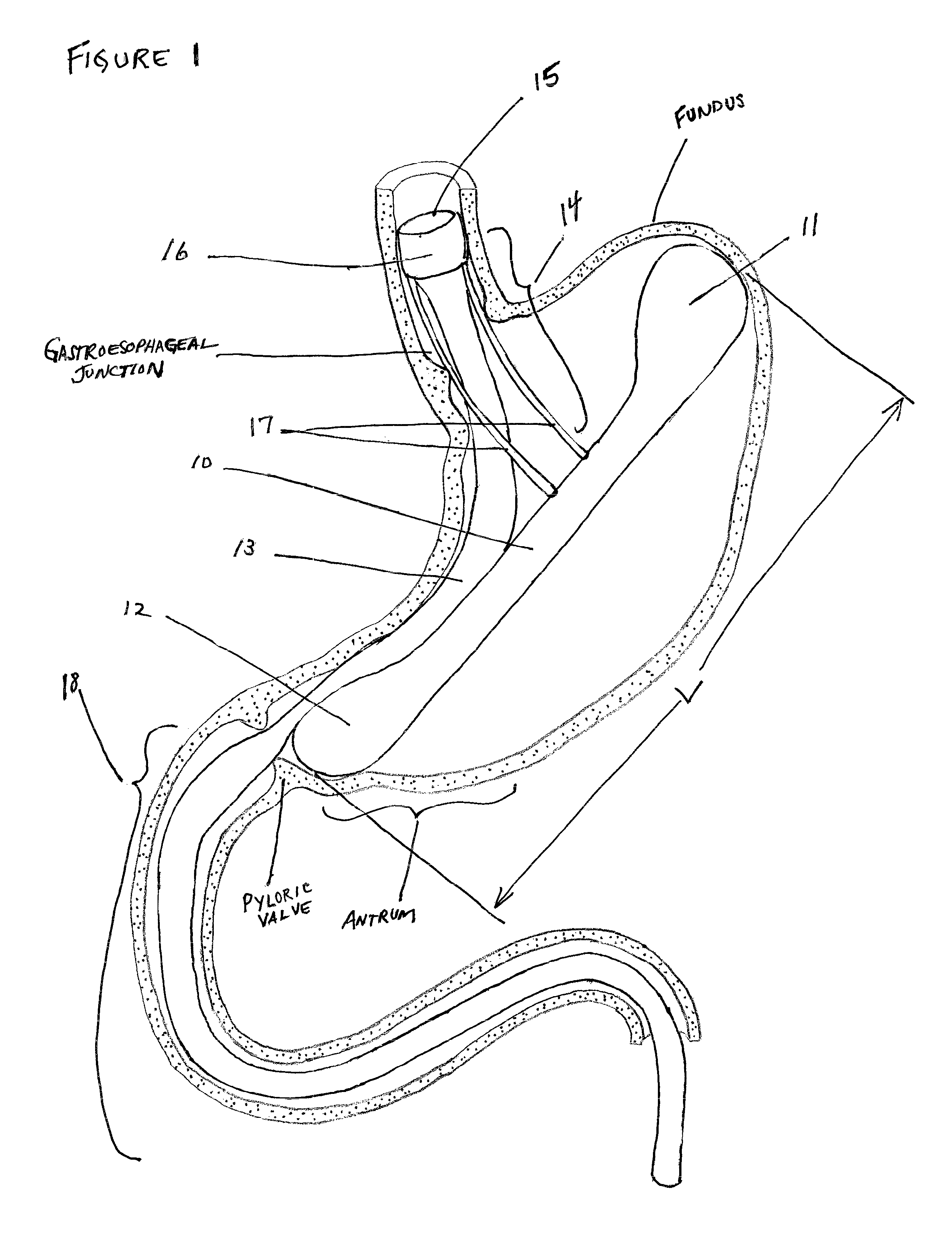 Intragastric implant devices