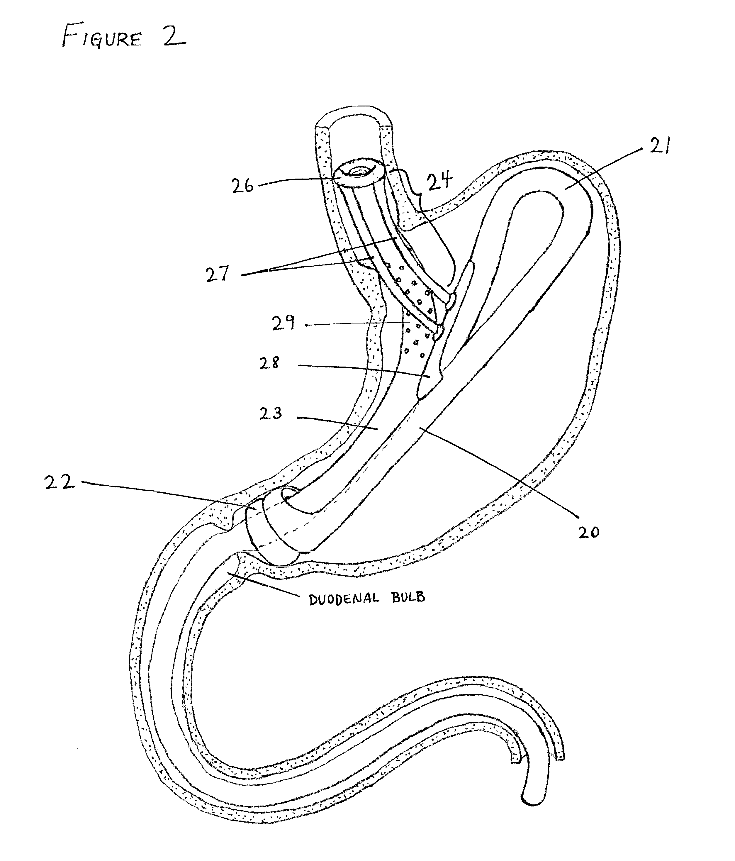 Intragastric implant devices