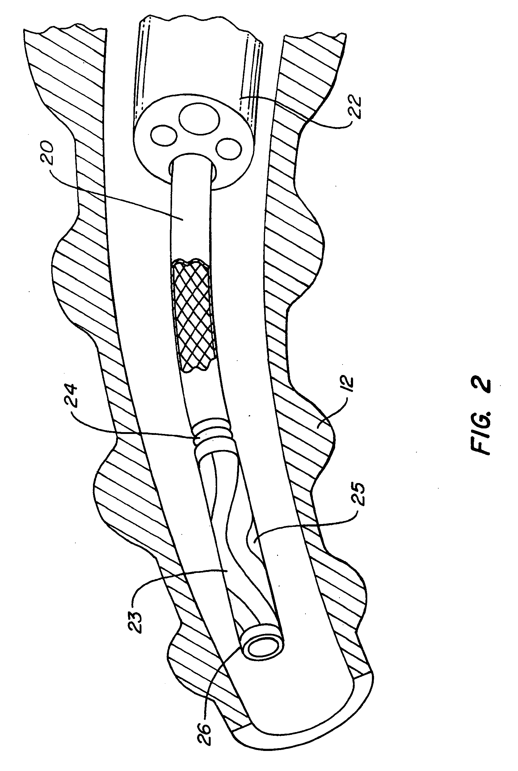 Method of reducing collateral flow in a portion of a lung