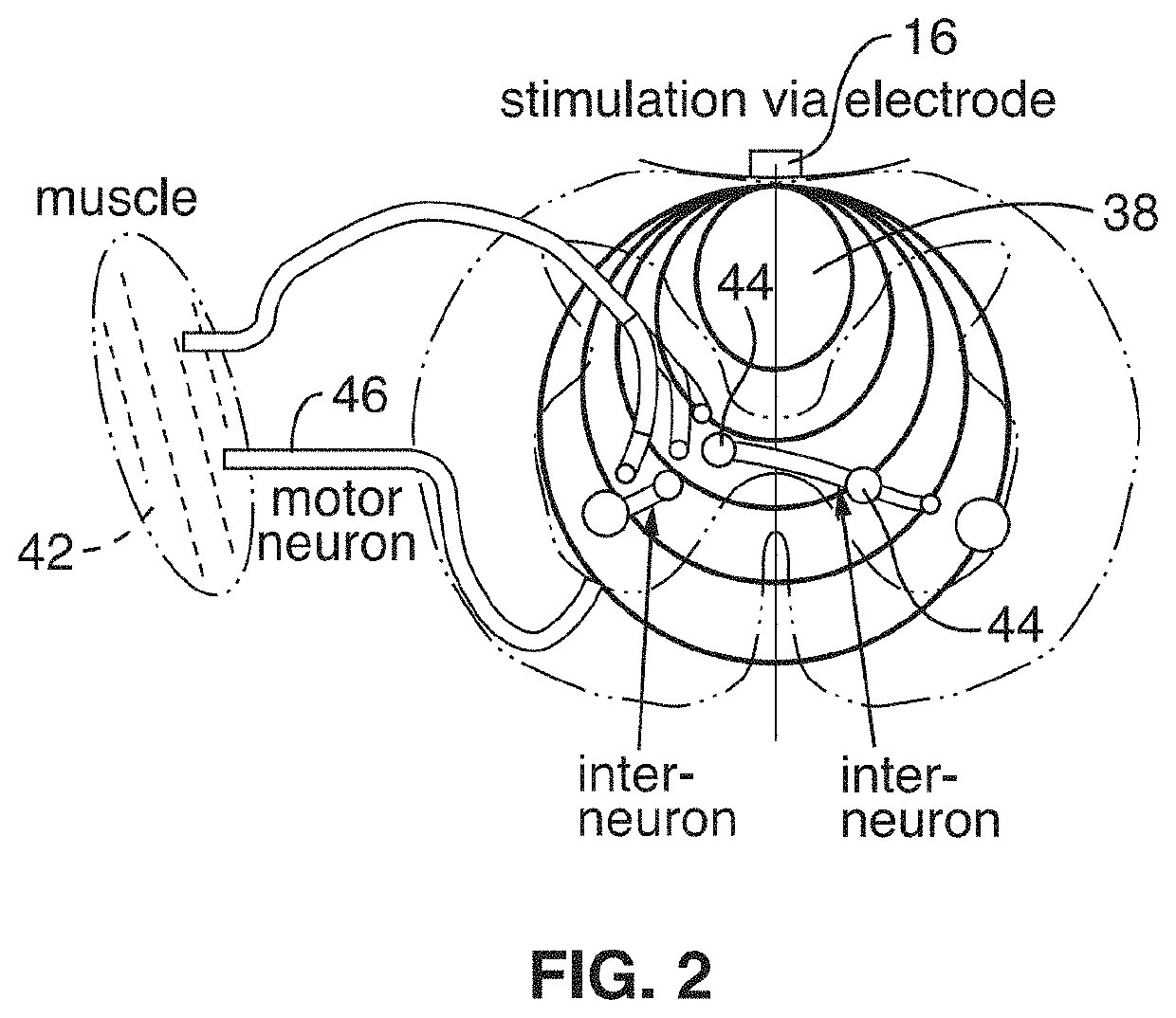 Wireless implant for motor function recovery after spinal cord injury