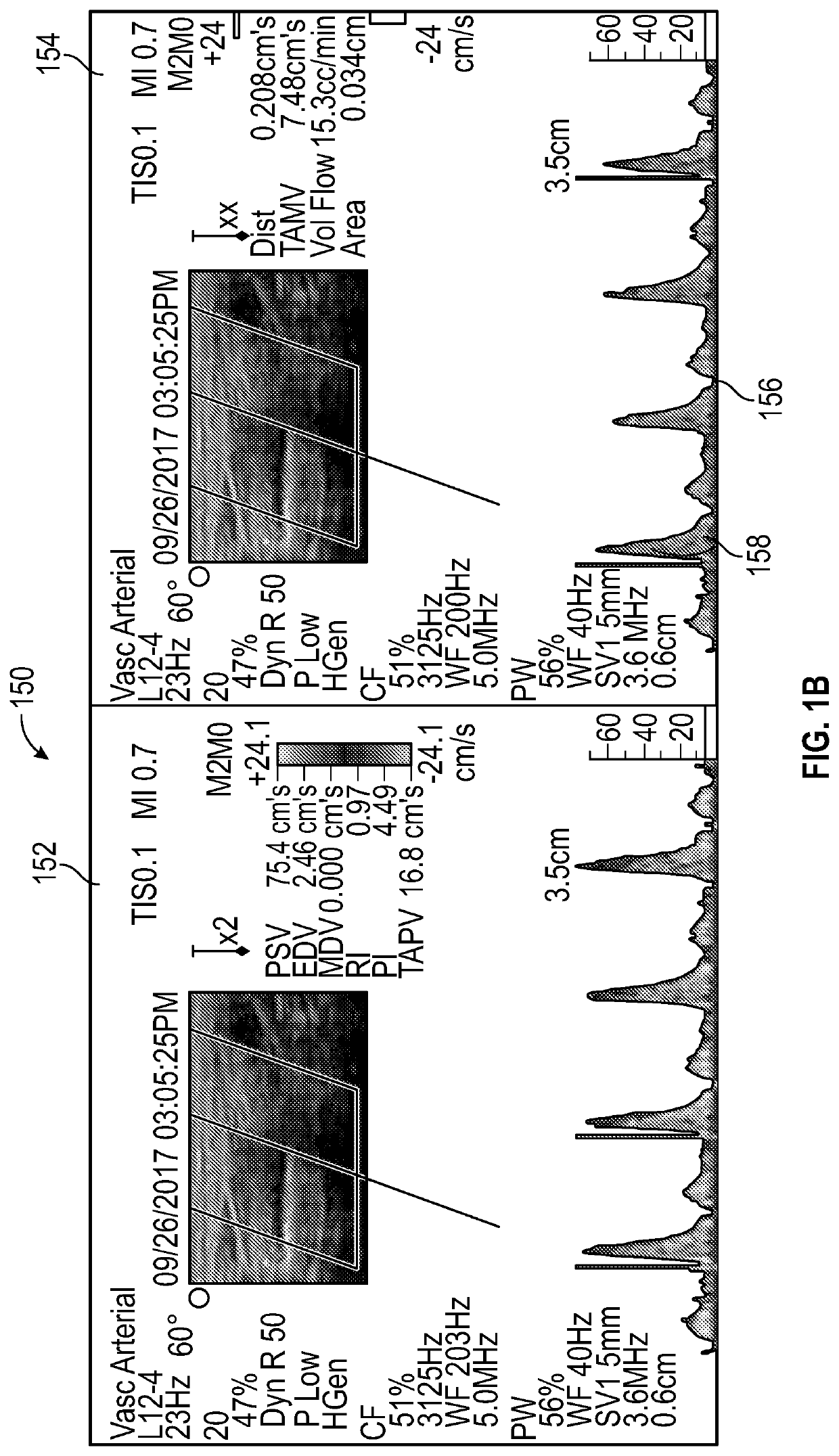 Computer-supported intraneural facilitation for vascular changes