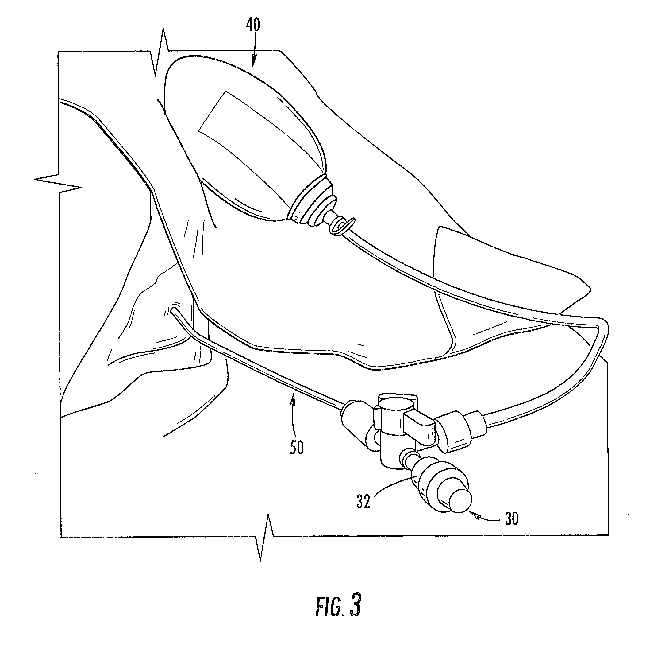 Subdural Drainage Catheter with Self Contained Mechanism for Restoration of Flow Following Catheter Obstruction