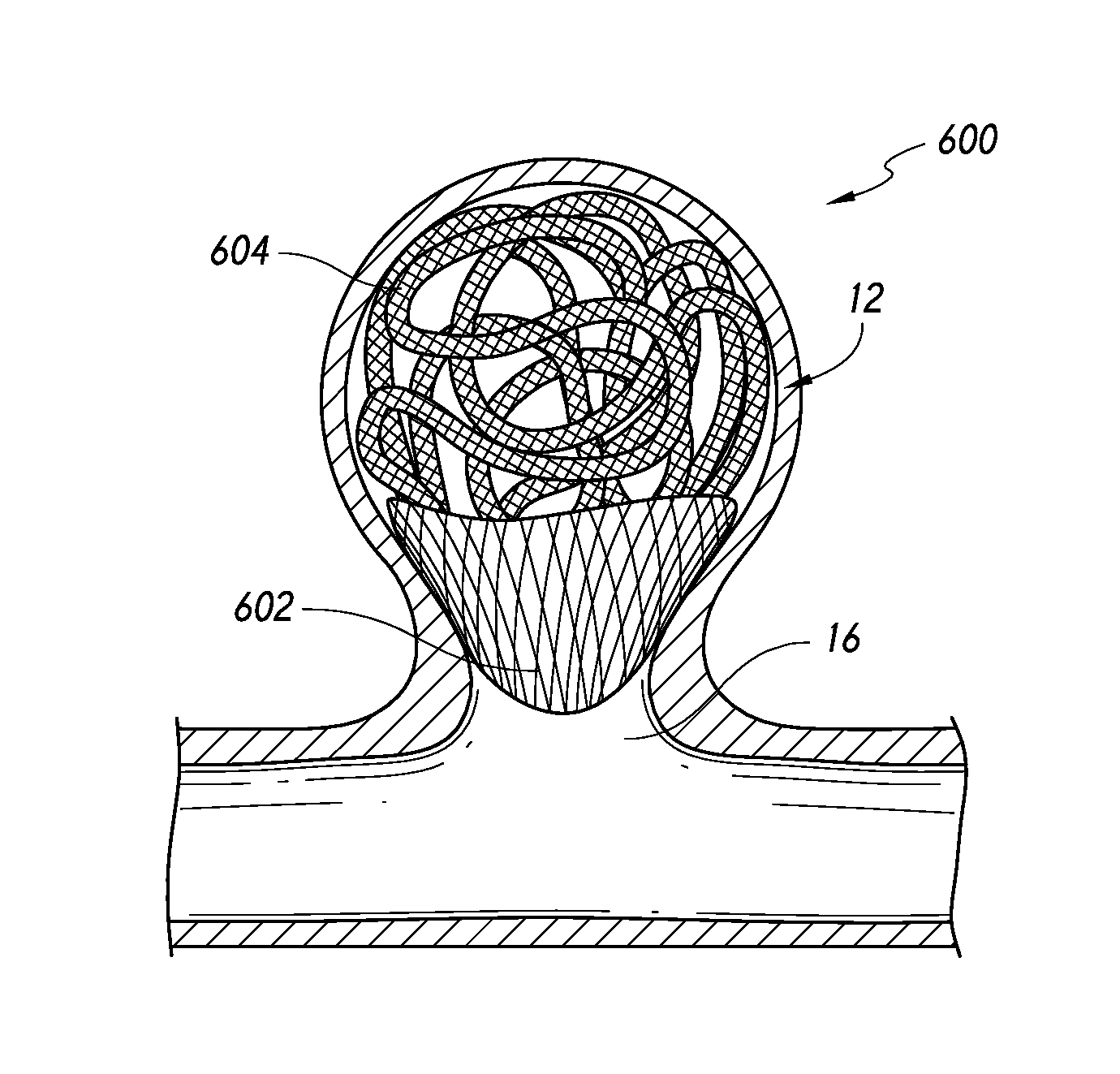 Occlusive Device