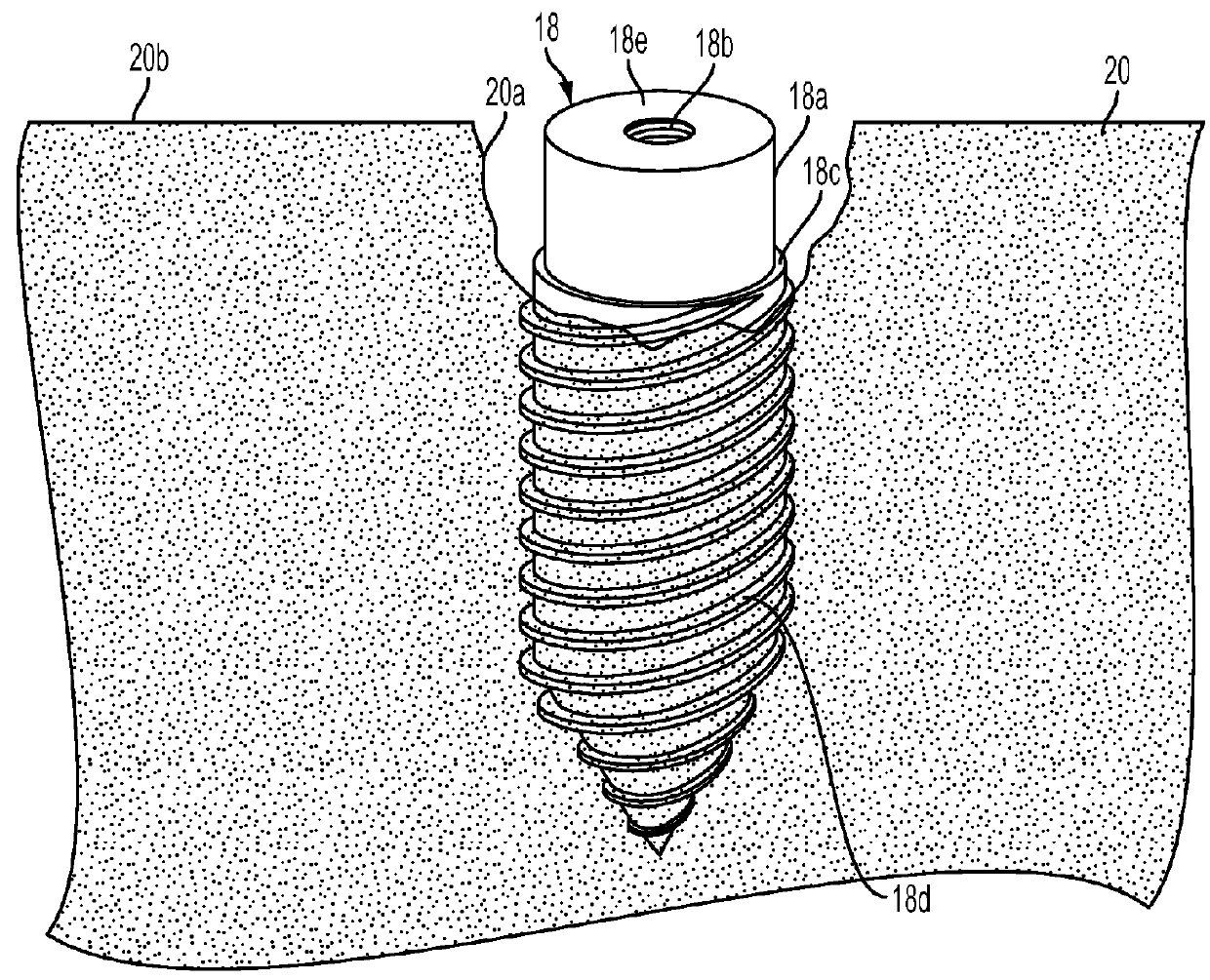 Method and apparatus to restore a tooth implant impaired by peri-implantitis