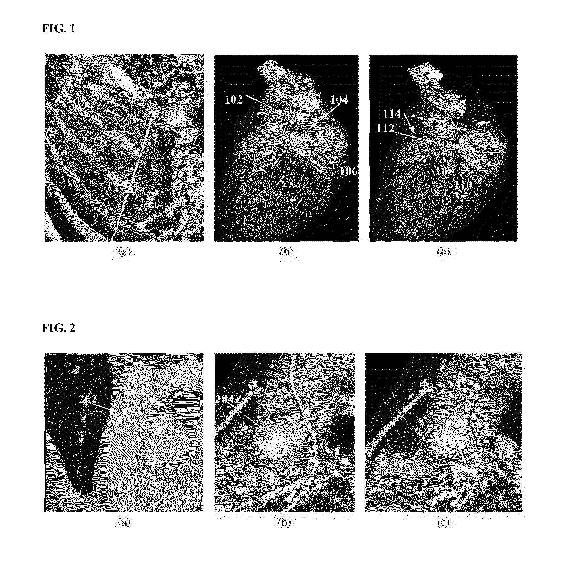 Method and system for segmentation and removal of pulmonary arteries, veins, left atrial appendage