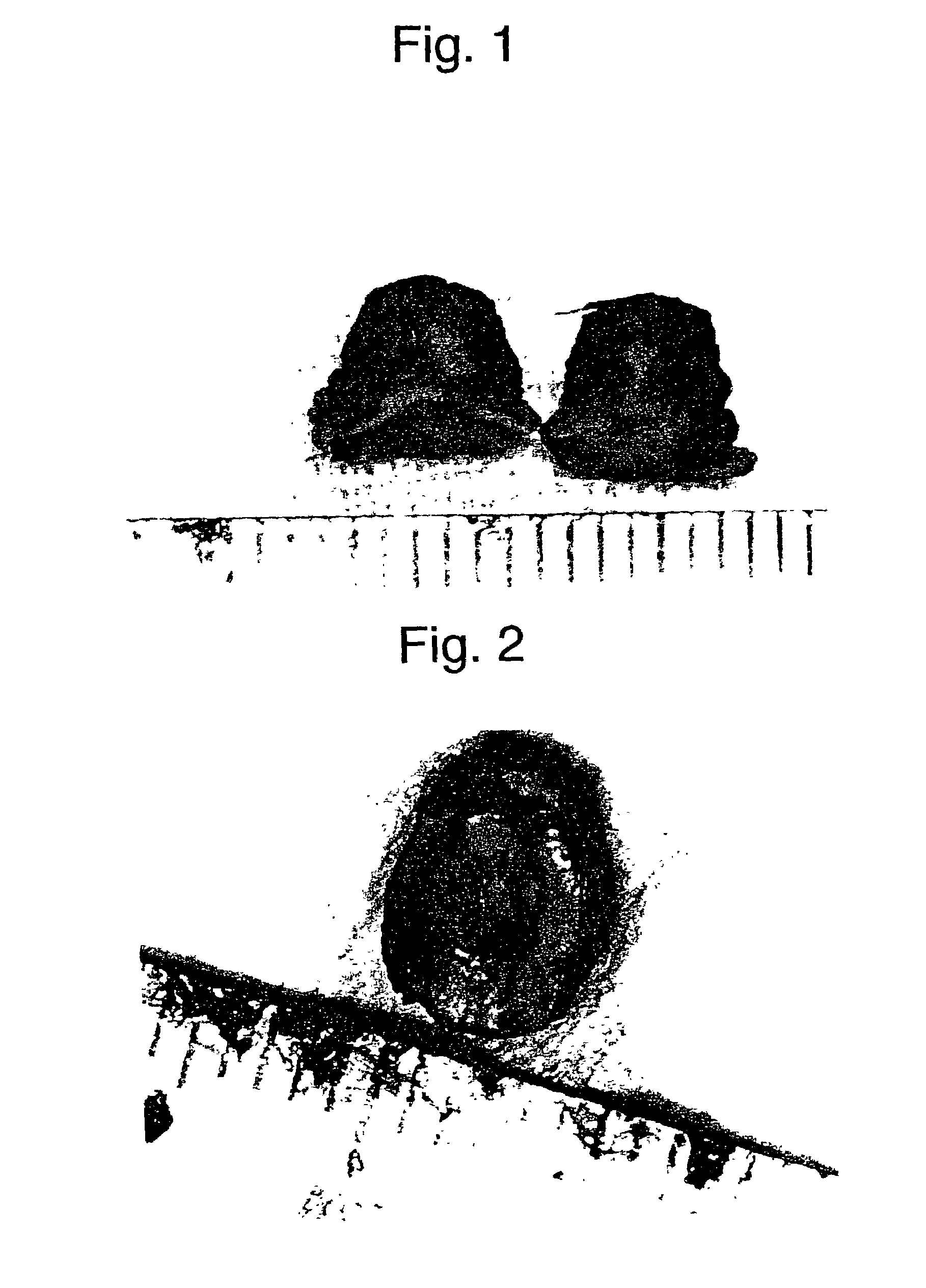 Vessel embolic material comprising hydrogel and therapy with the use thereof