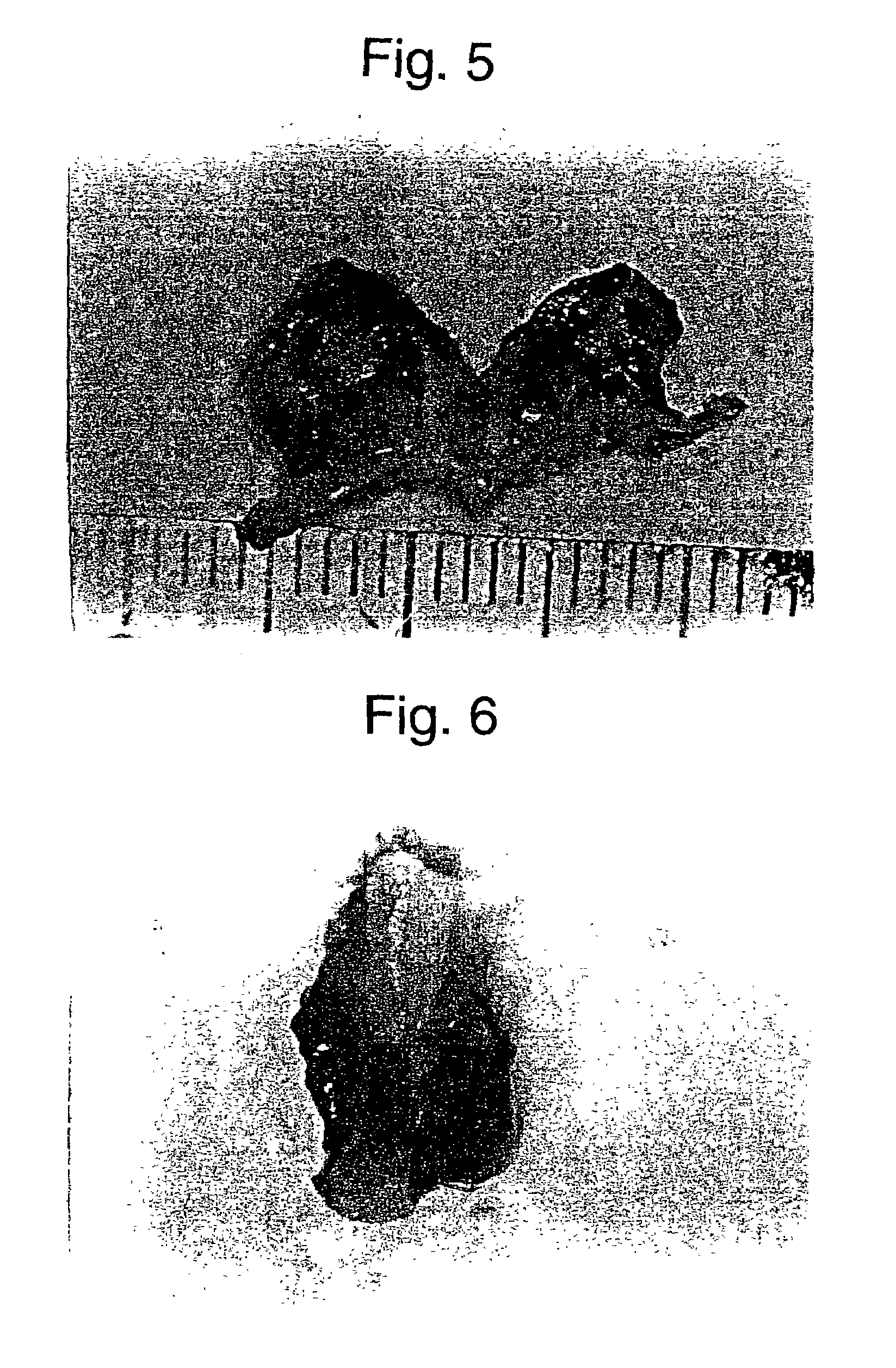 Vessel embolic material comprising hydrogel and therapy with the use thereof