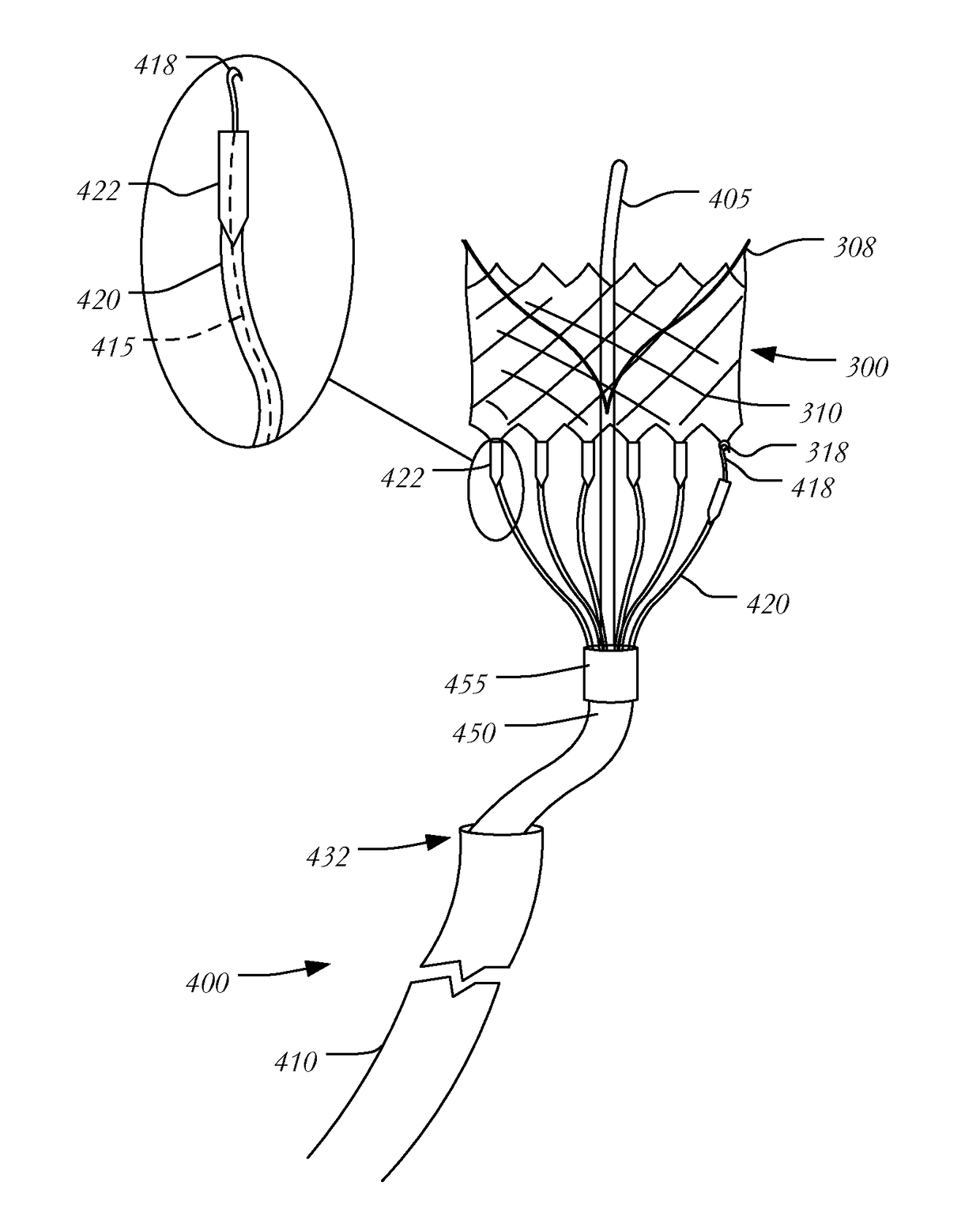 Transapical mitral valve replacement