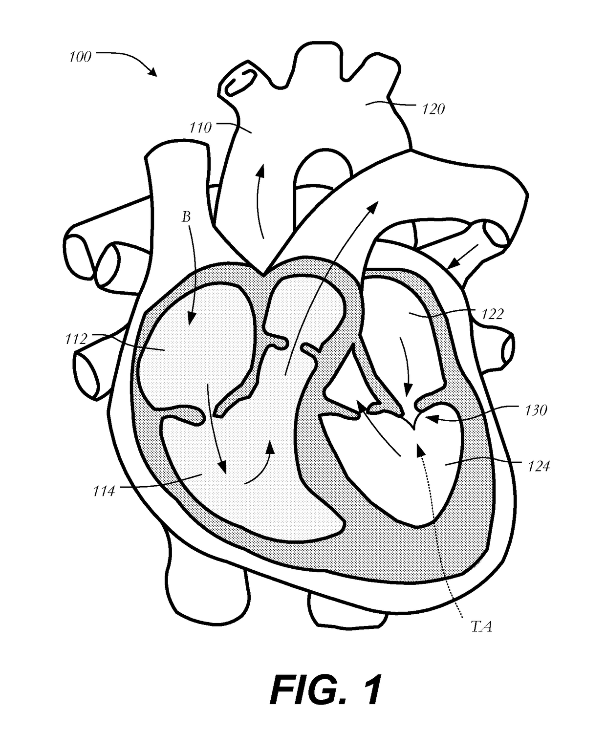 Transapical mitral valve replacement