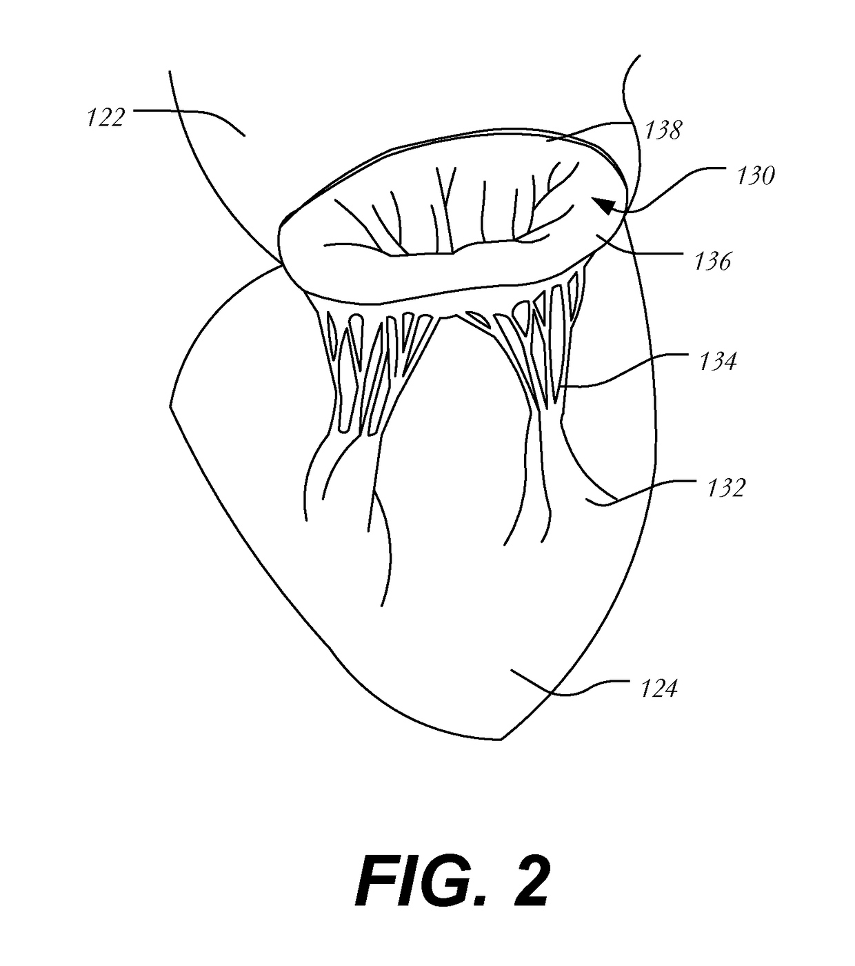 Transapical mitral valve replacement