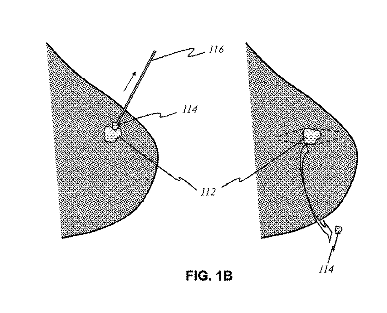 Imaging system for screening and diagnosis of breast cancer