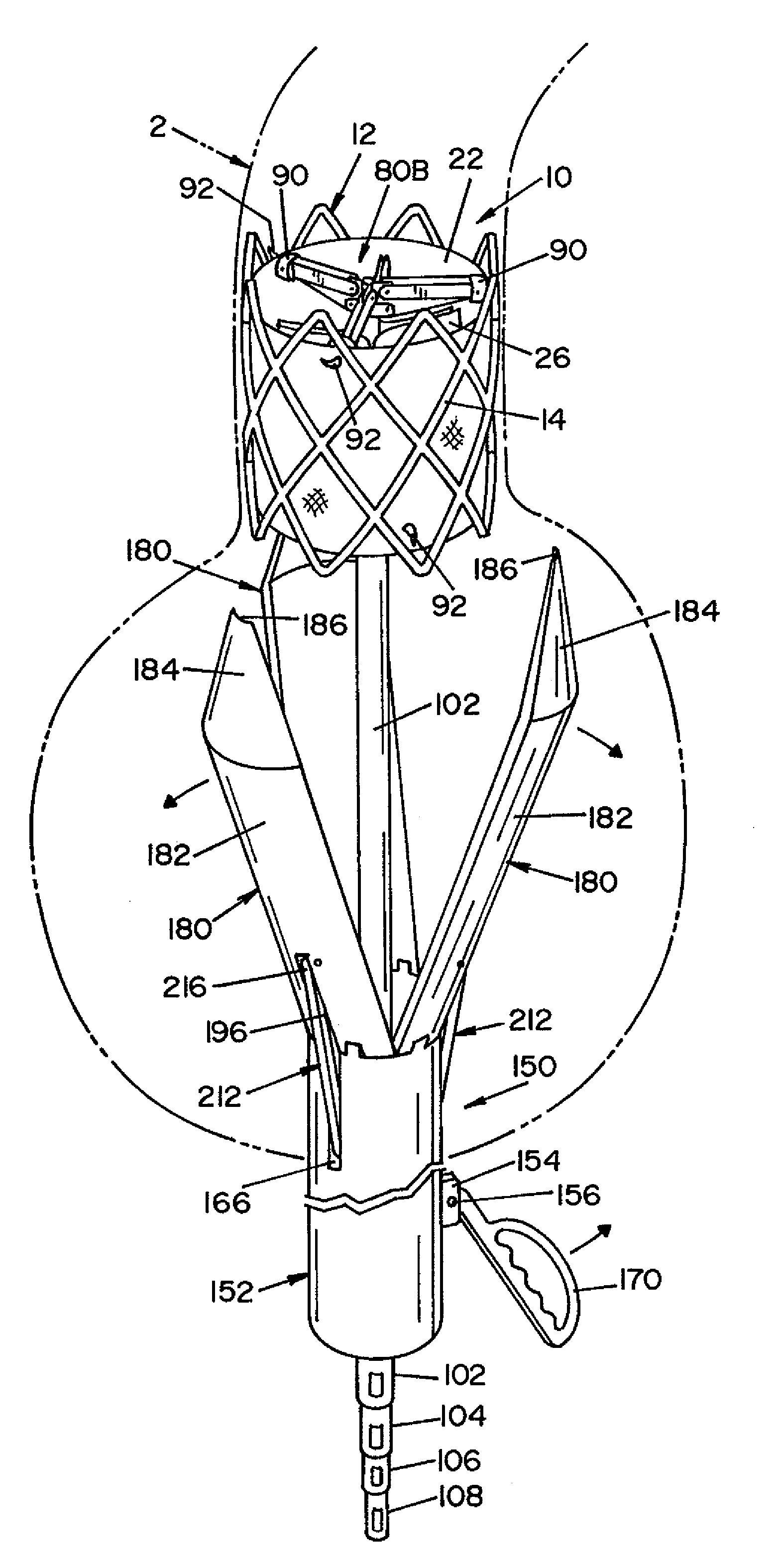 Method and apparatus for prosthetic valve removal