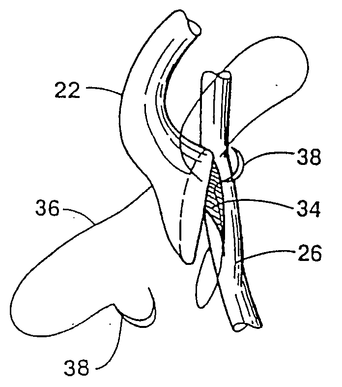 Method for coronary artery bypass