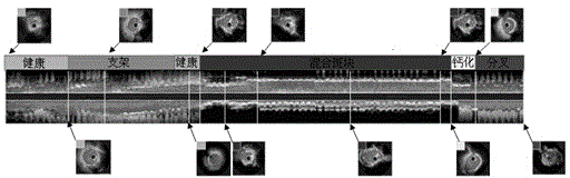 Automatic retrieval method of key frame in IVUS video