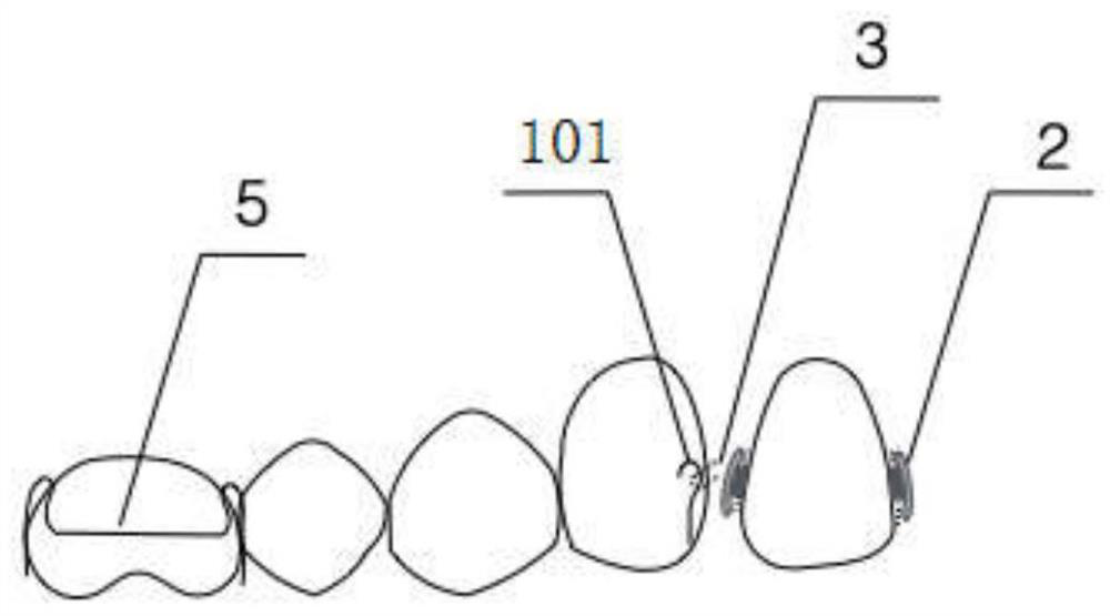 Upper anterior tooth 90-degree torsion appliance and preparation method thereof